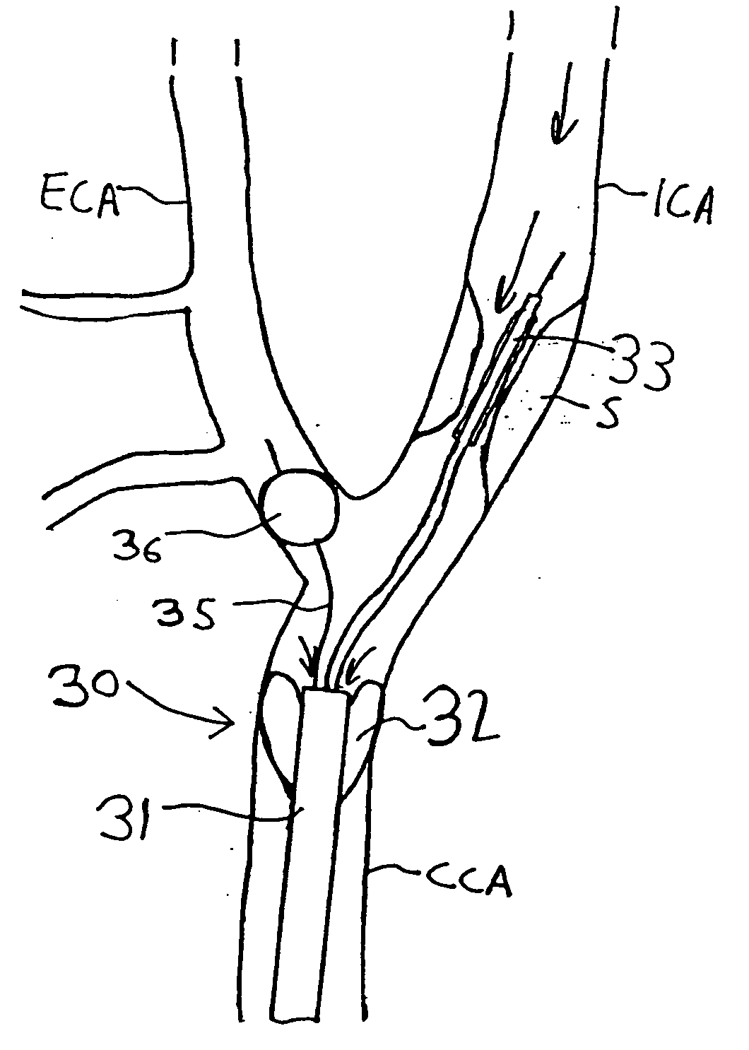 Apparatus and methods for reducing embolization during treatment of carotid artery disease