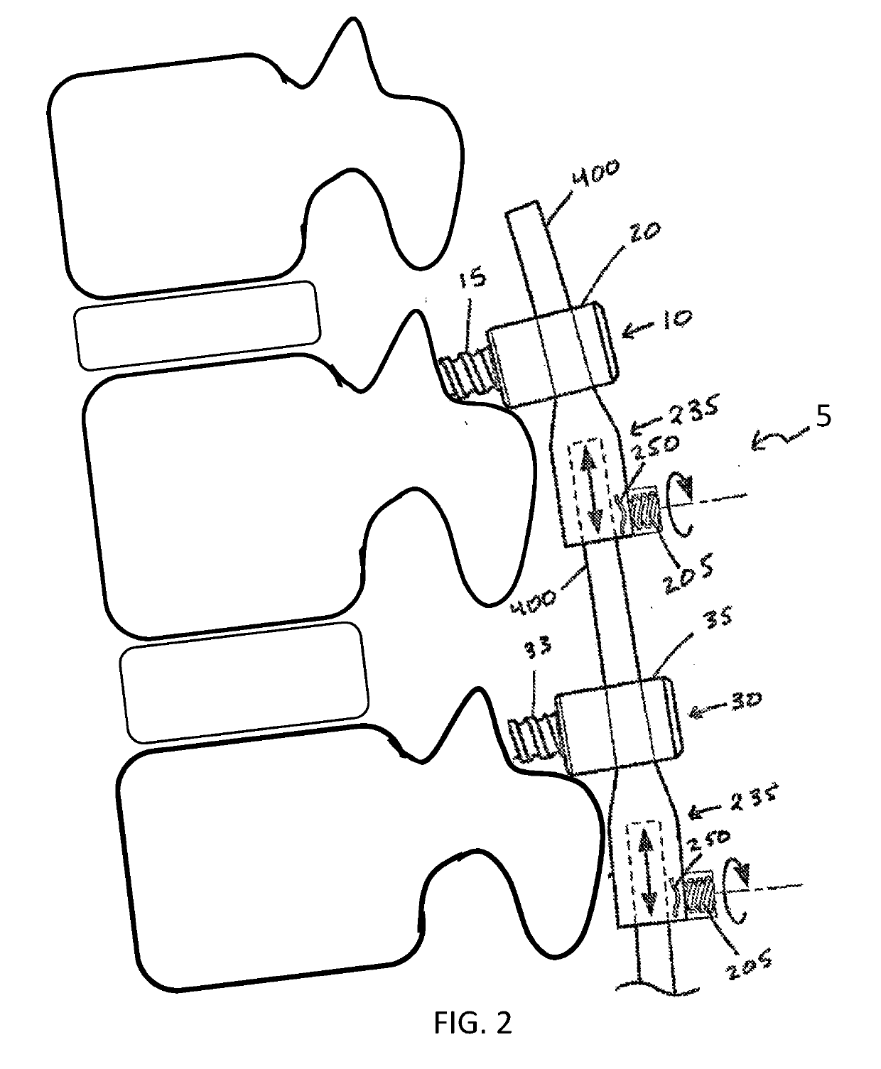 Post-Operatively Adjustable Spinal Fixation Devices