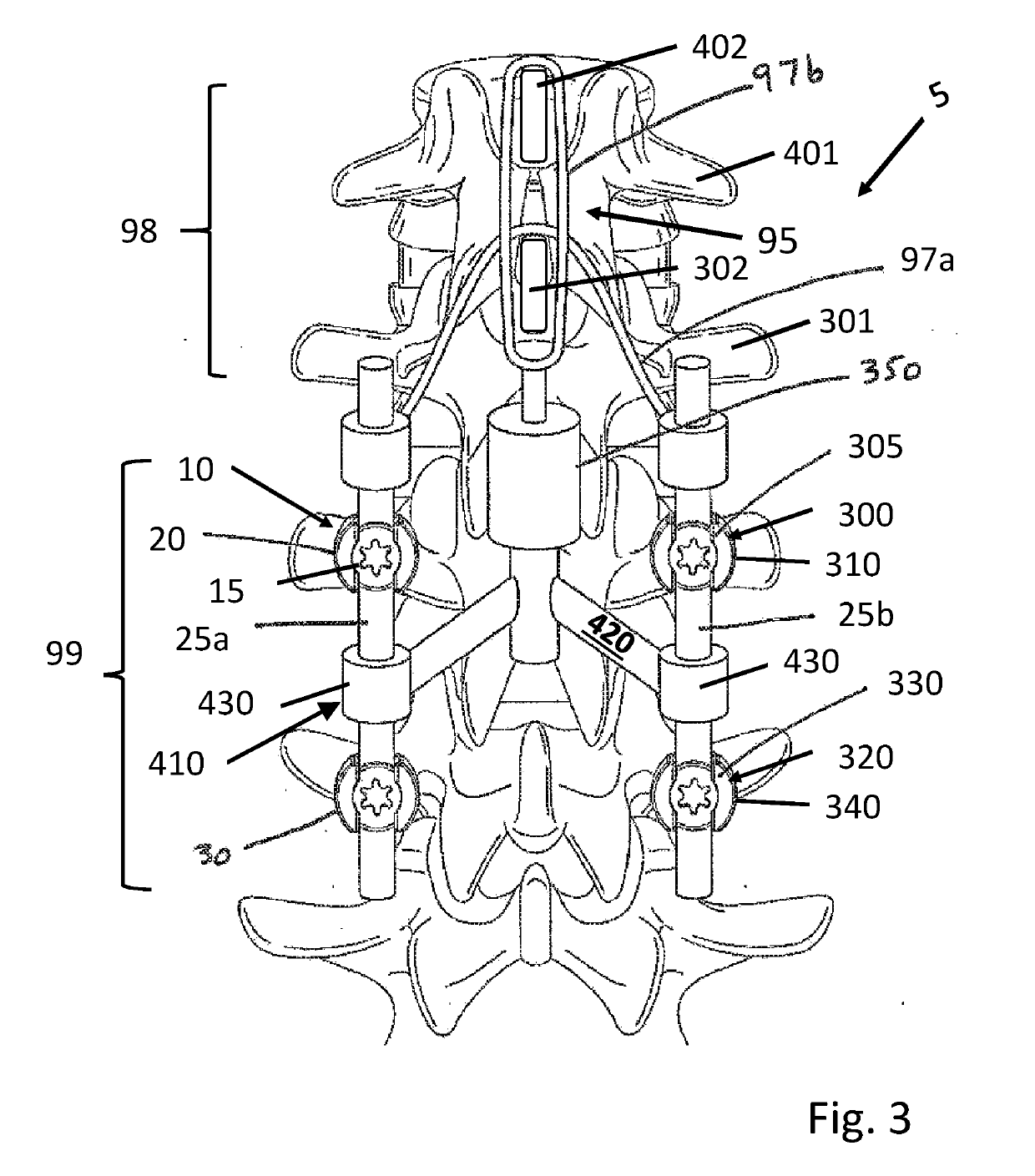 Post-Operatively Adjustable Spinal Fixation Devices