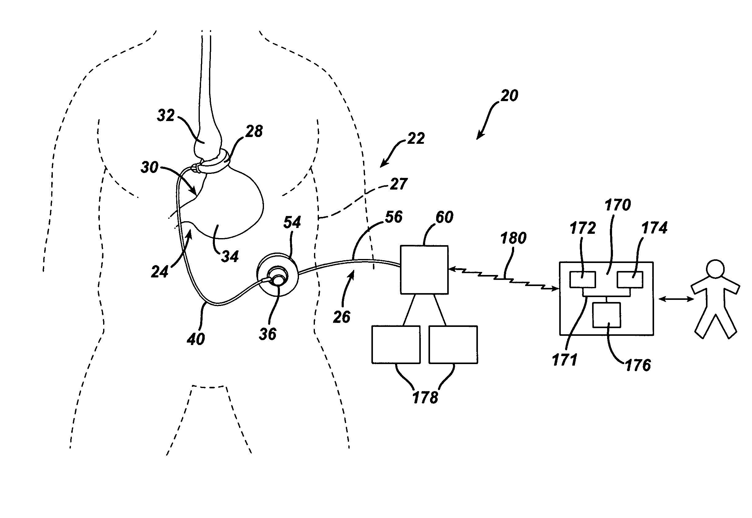 GUI for an Implantable Restriction Device and a Data Logger