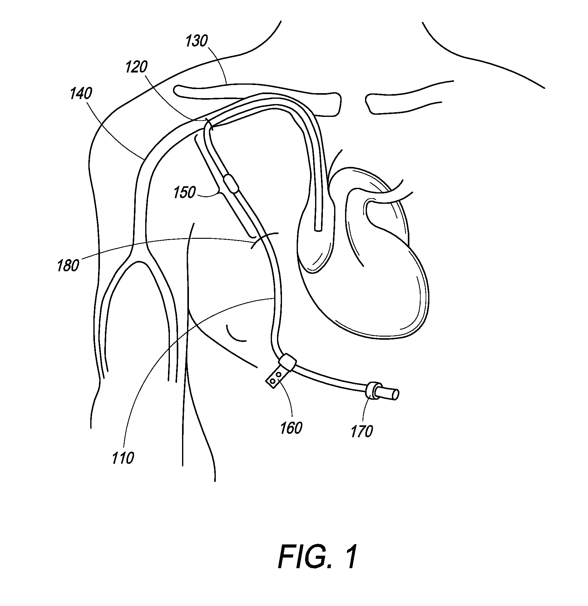 Method and Systems for Controlling Ultrafiltration Using Central Venous Pressure Measurements