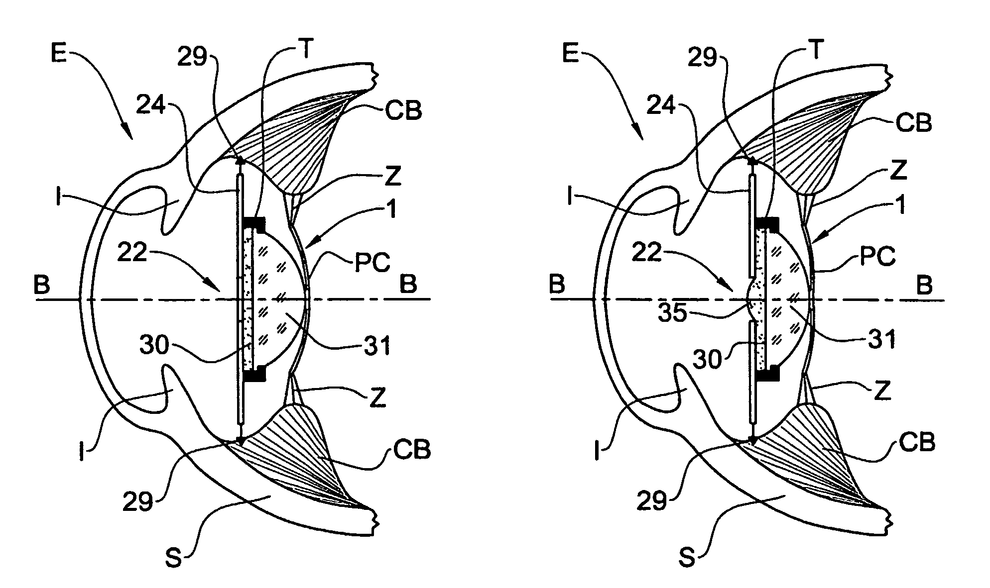 Accommodating lens assembly