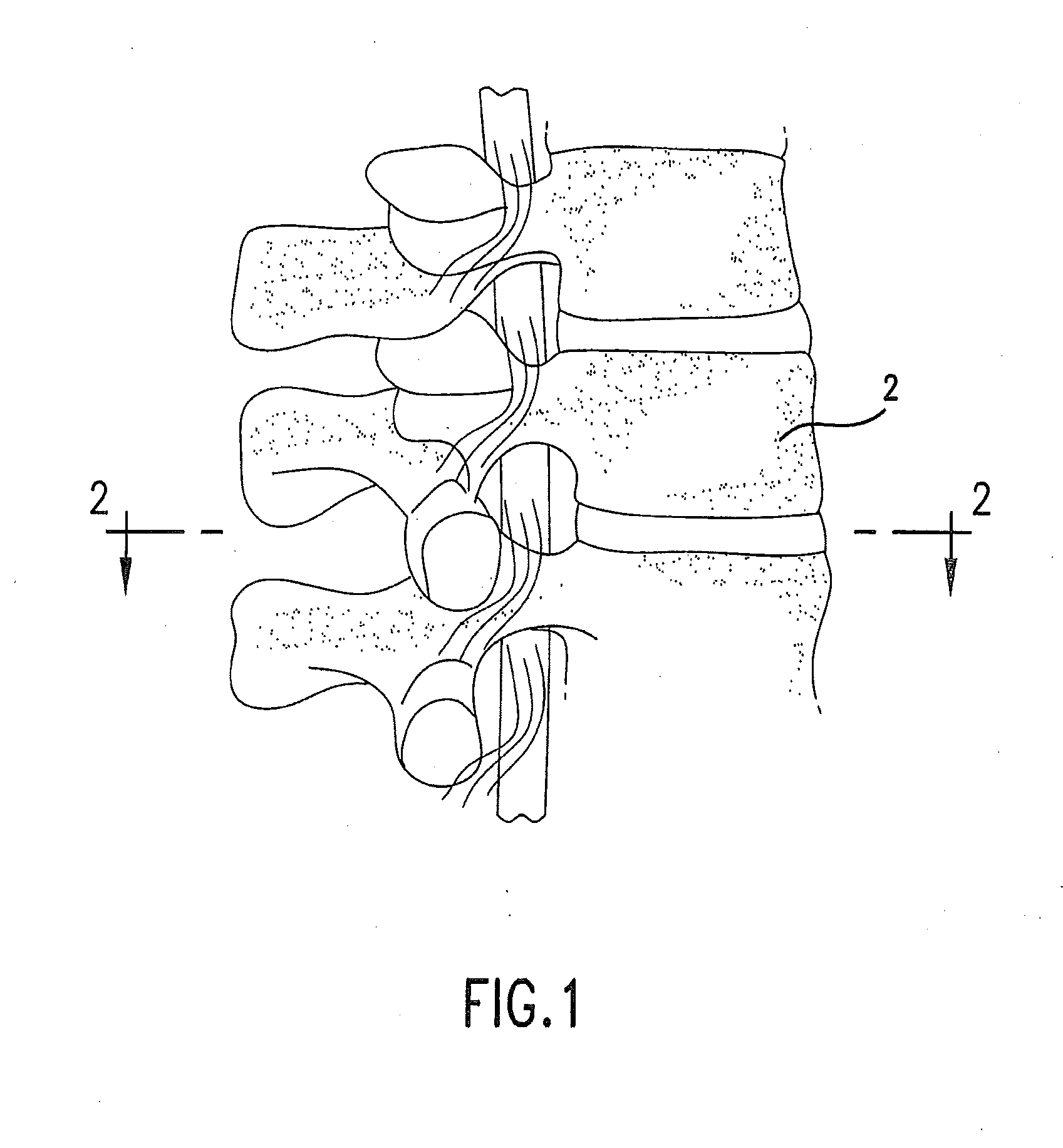 Method and device for placing materials in the spine