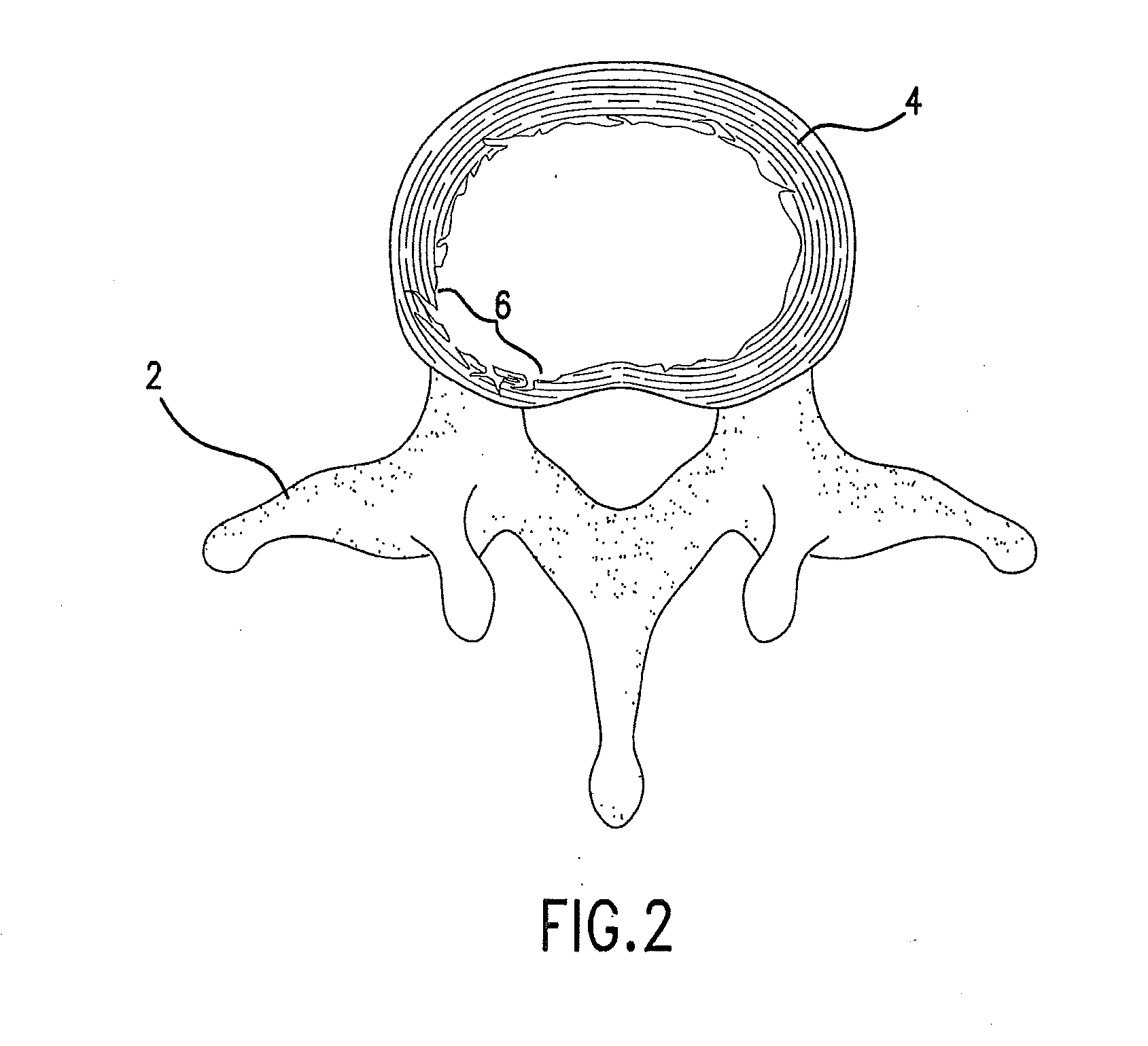 Method and device for placing materials in the spine