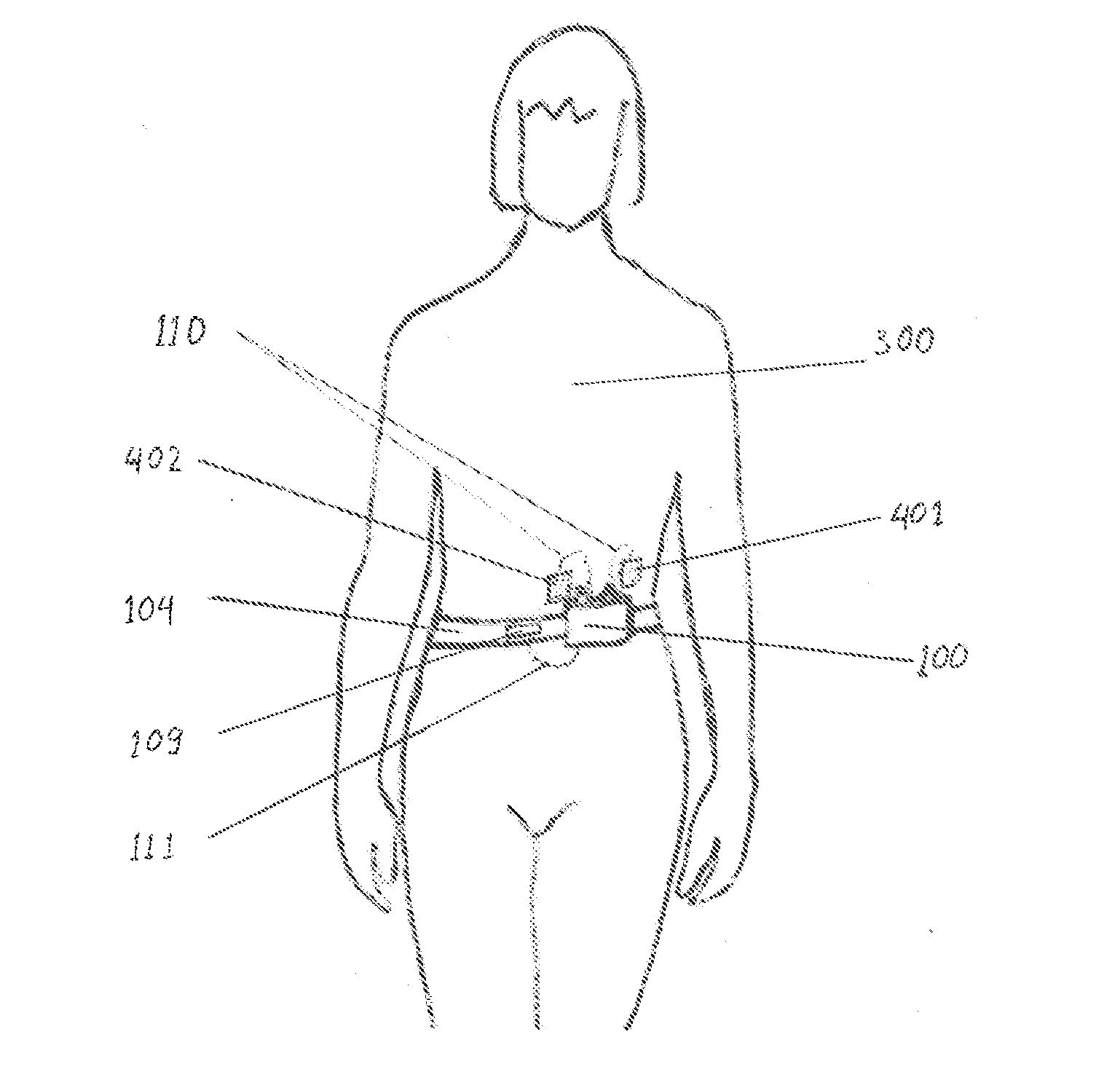 Non-invasive device and method for treating gastro esophageal reflux disease (GERD) and the digestive system