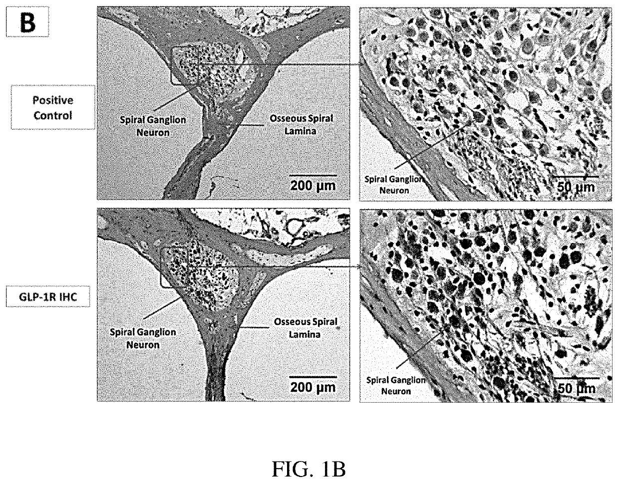 Uses of glucagon-like peptide-1 receptor agonists for treating trauma-induced hearing loss