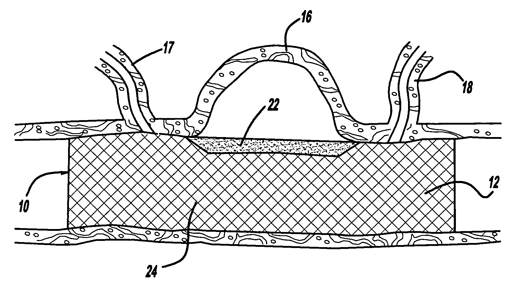 Expandable stent having a stabilized portion