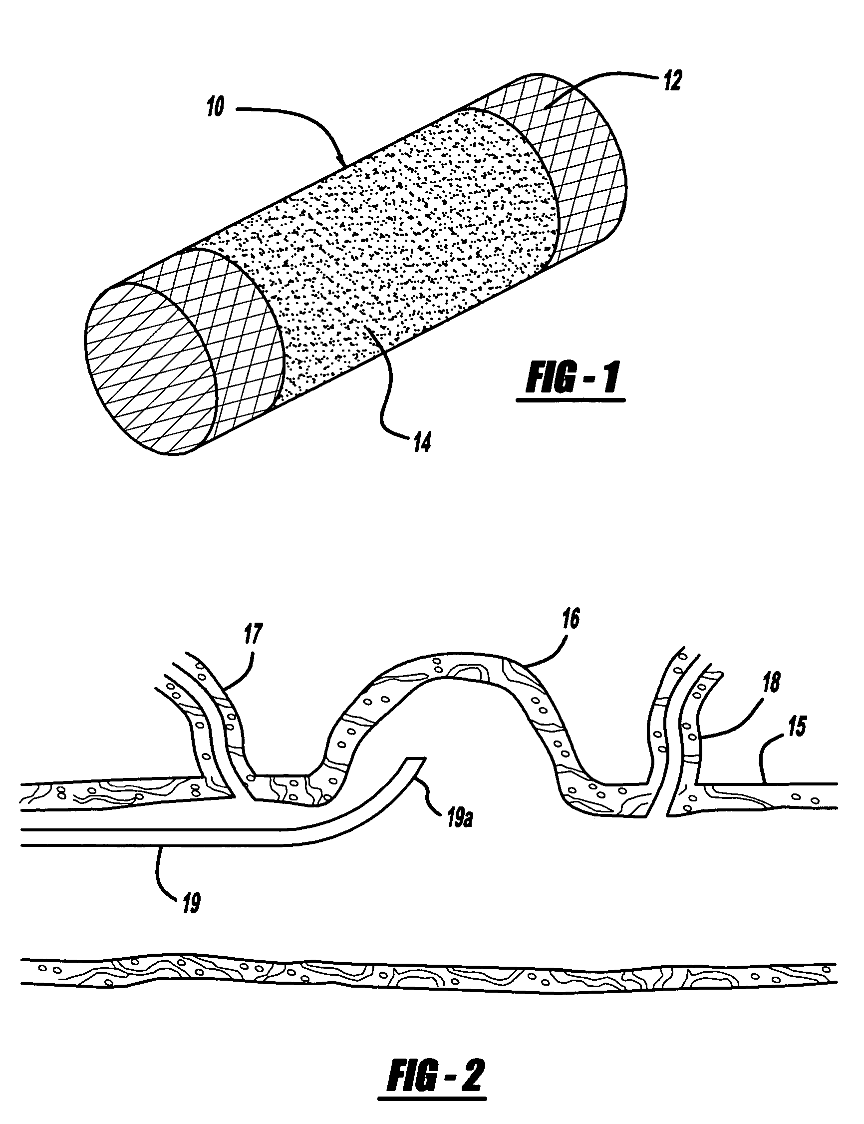 Expandable stent having a stabilized portion