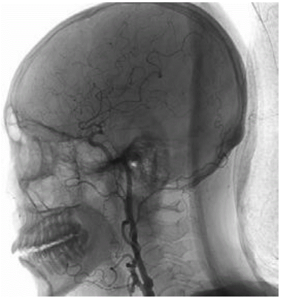 DSA Vascular Image Segmentation Method Based on Sift Feature Point Clustering and Boolean Difference Operation