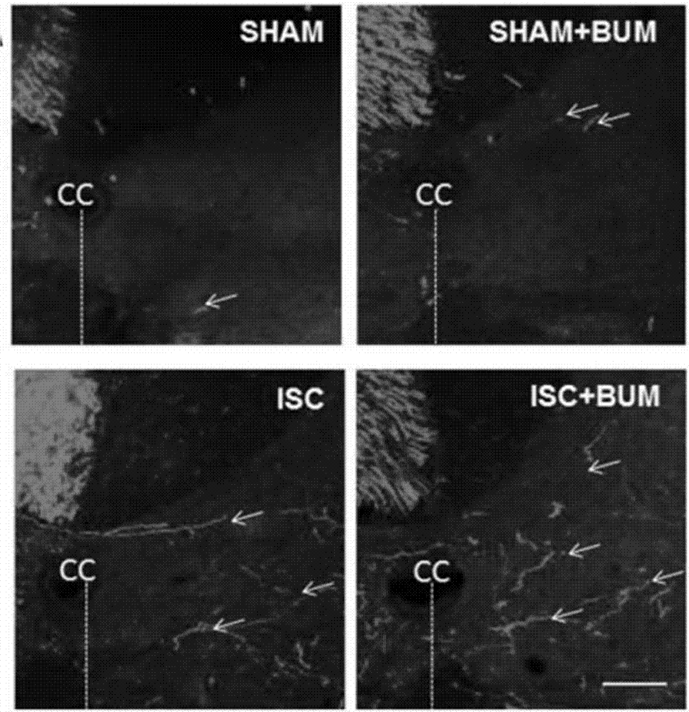 Application of bumetanide in promoting neural functional reconstruction in recovery period after ischemic stroke