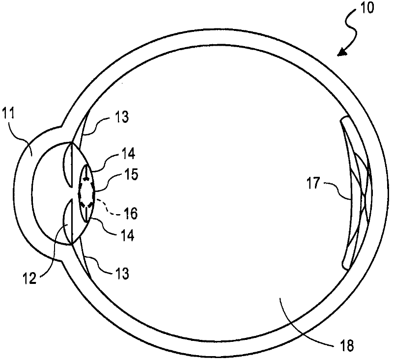 Intraocular lens and method of compensating for changes in capsule size and changes in the eye after implantation