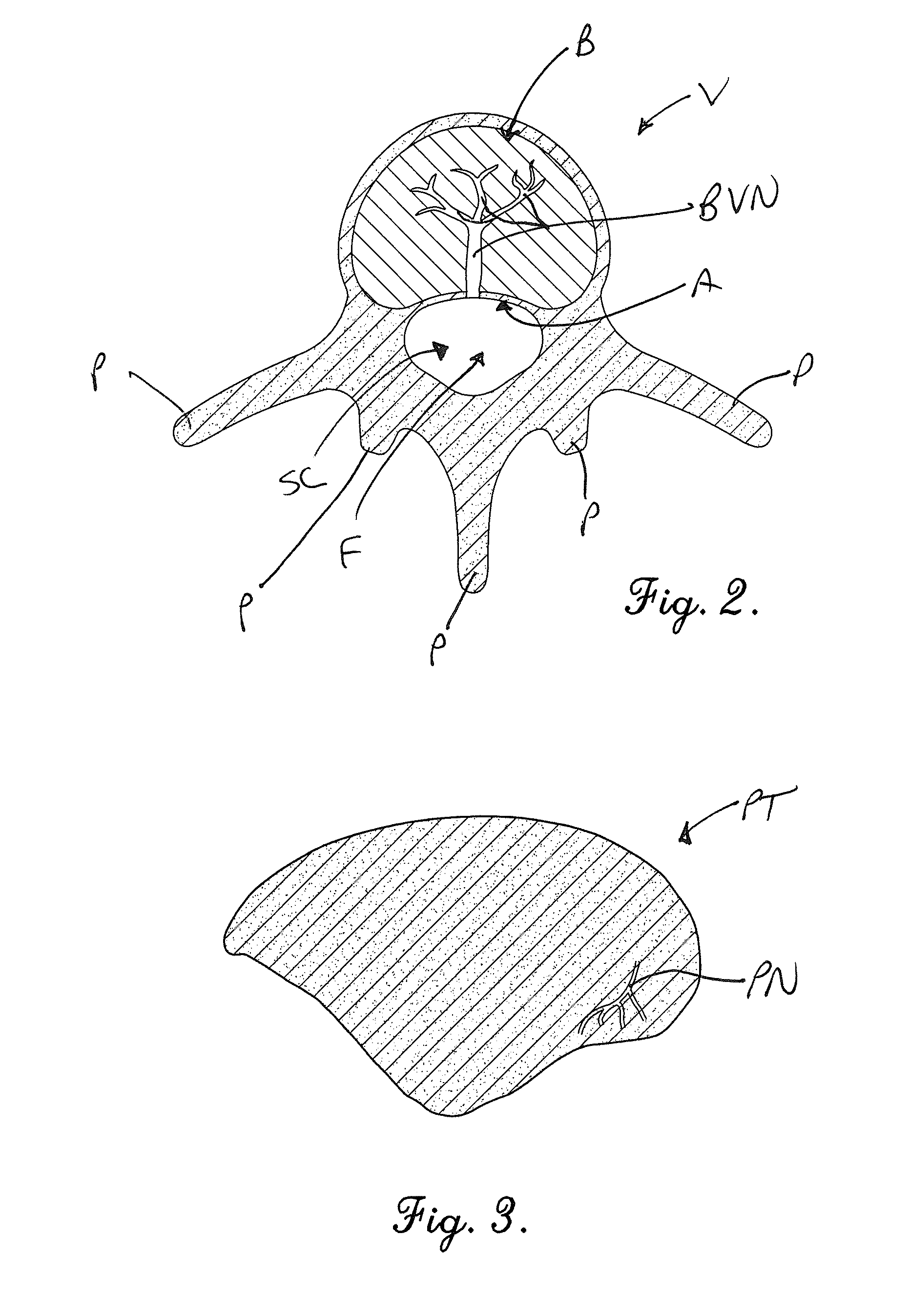 Device and method for alleviation of pain