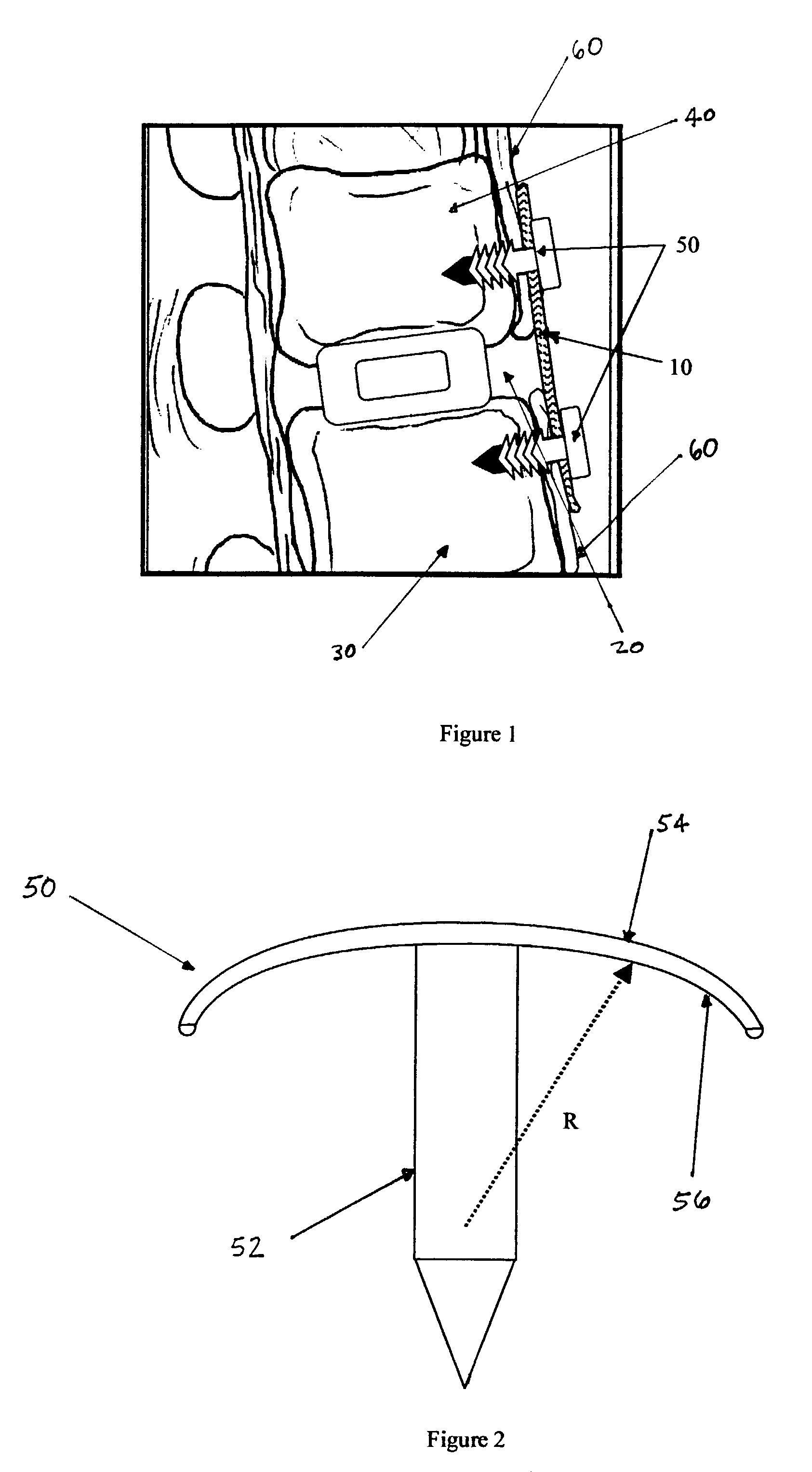Regenerative implants for stabilizing the spine and devices for attachment of said implants