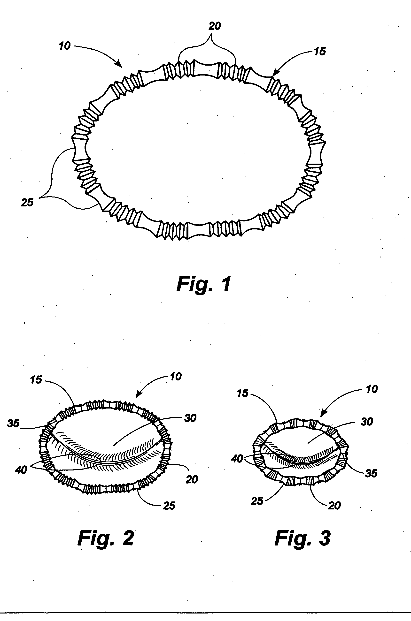 Methods and apparatus for controlling the internal circumference of an anatomic orifice or lumen