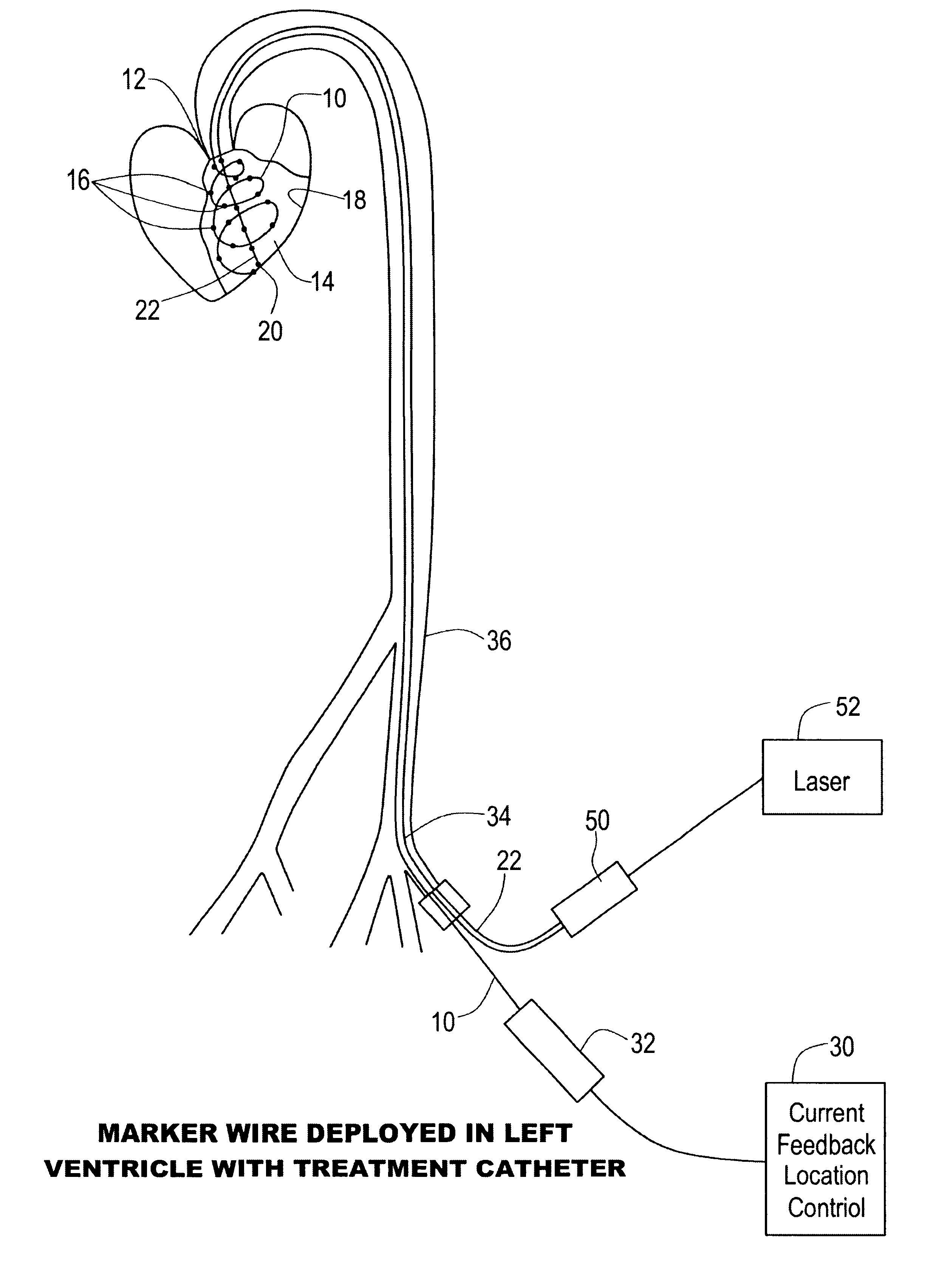 Percutaneous mapping system