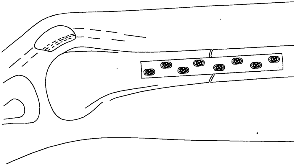 Multifunctional traction and fixing device for bone setting