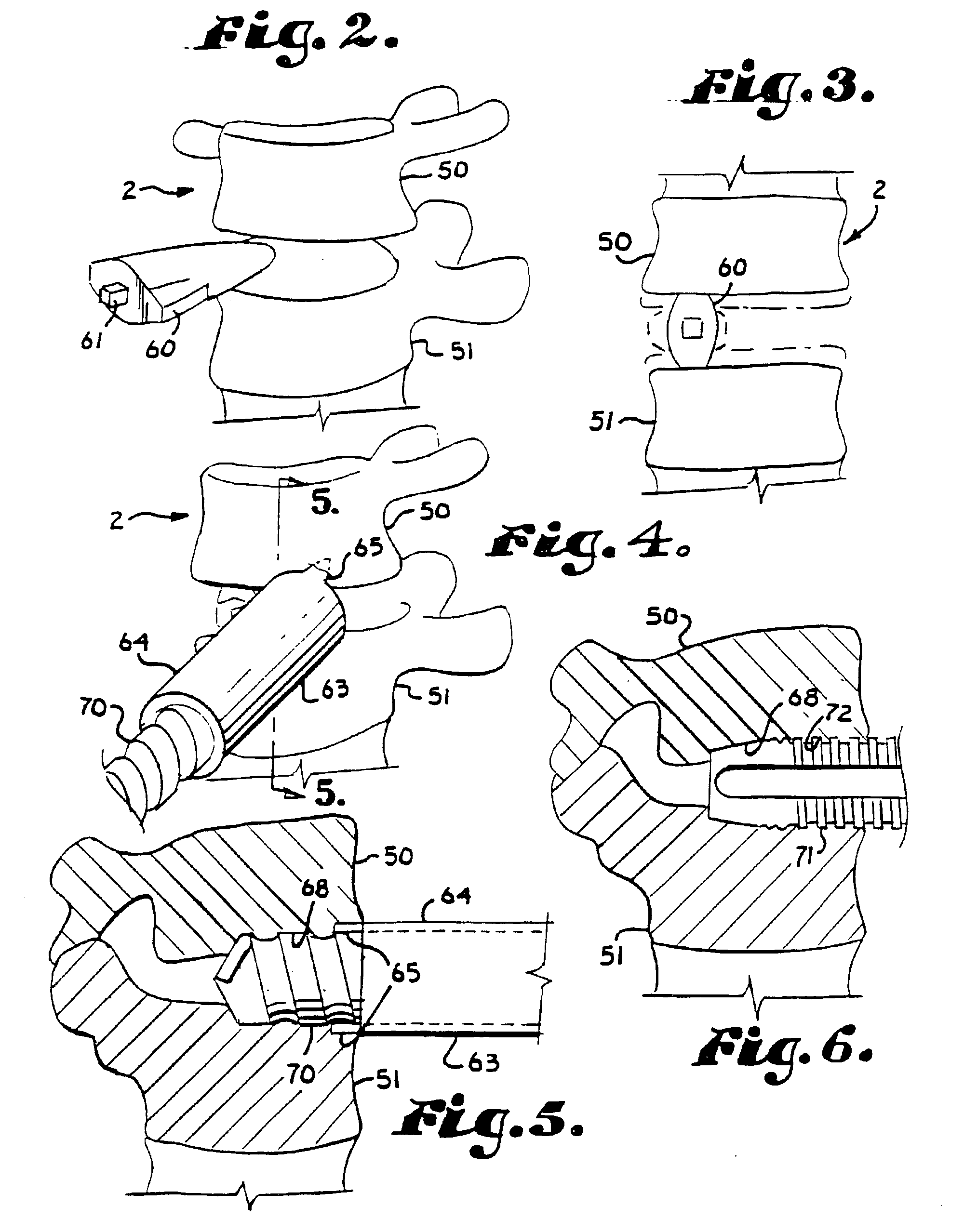Spinal fusion apparatus and method