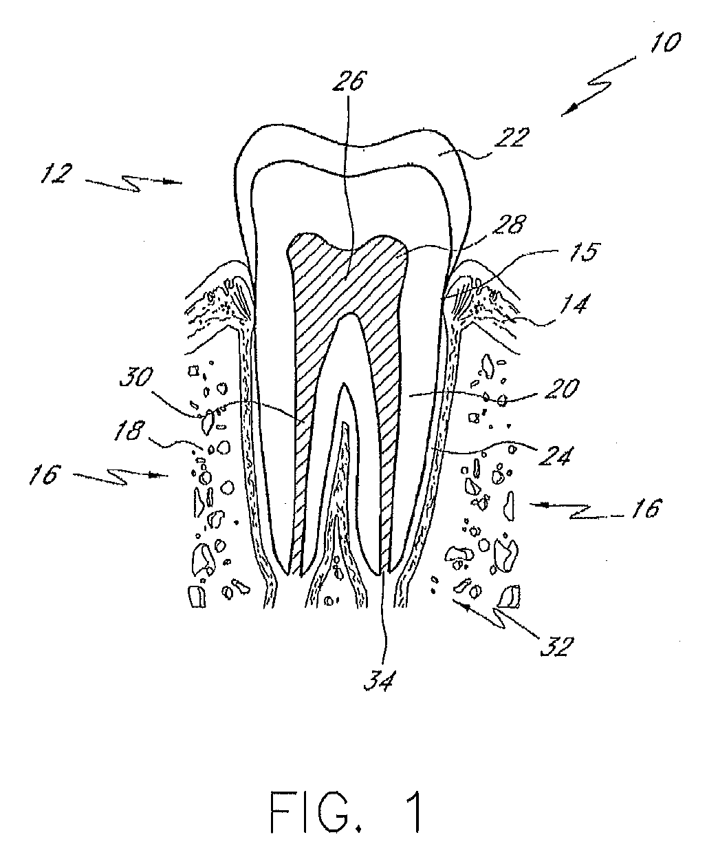 Liquid jet apparatus and methods for dental treatments