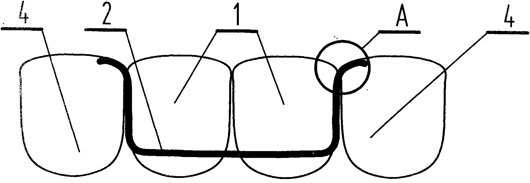 Method for inserting false teeth