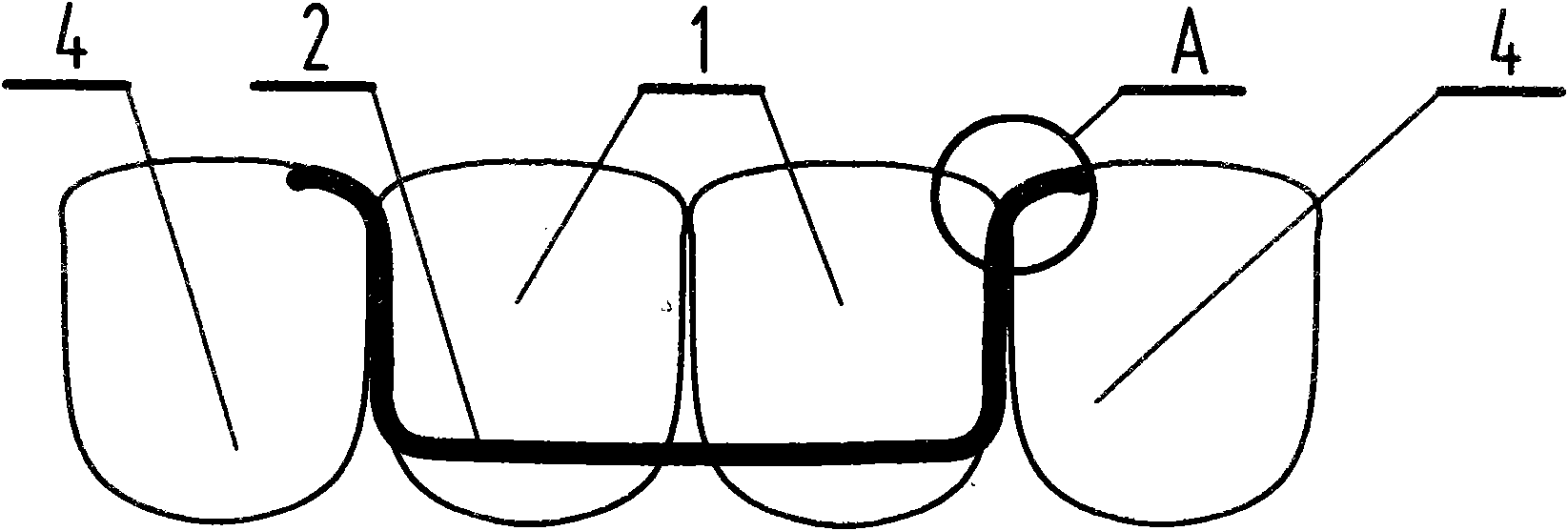 Method for inserting false teeth