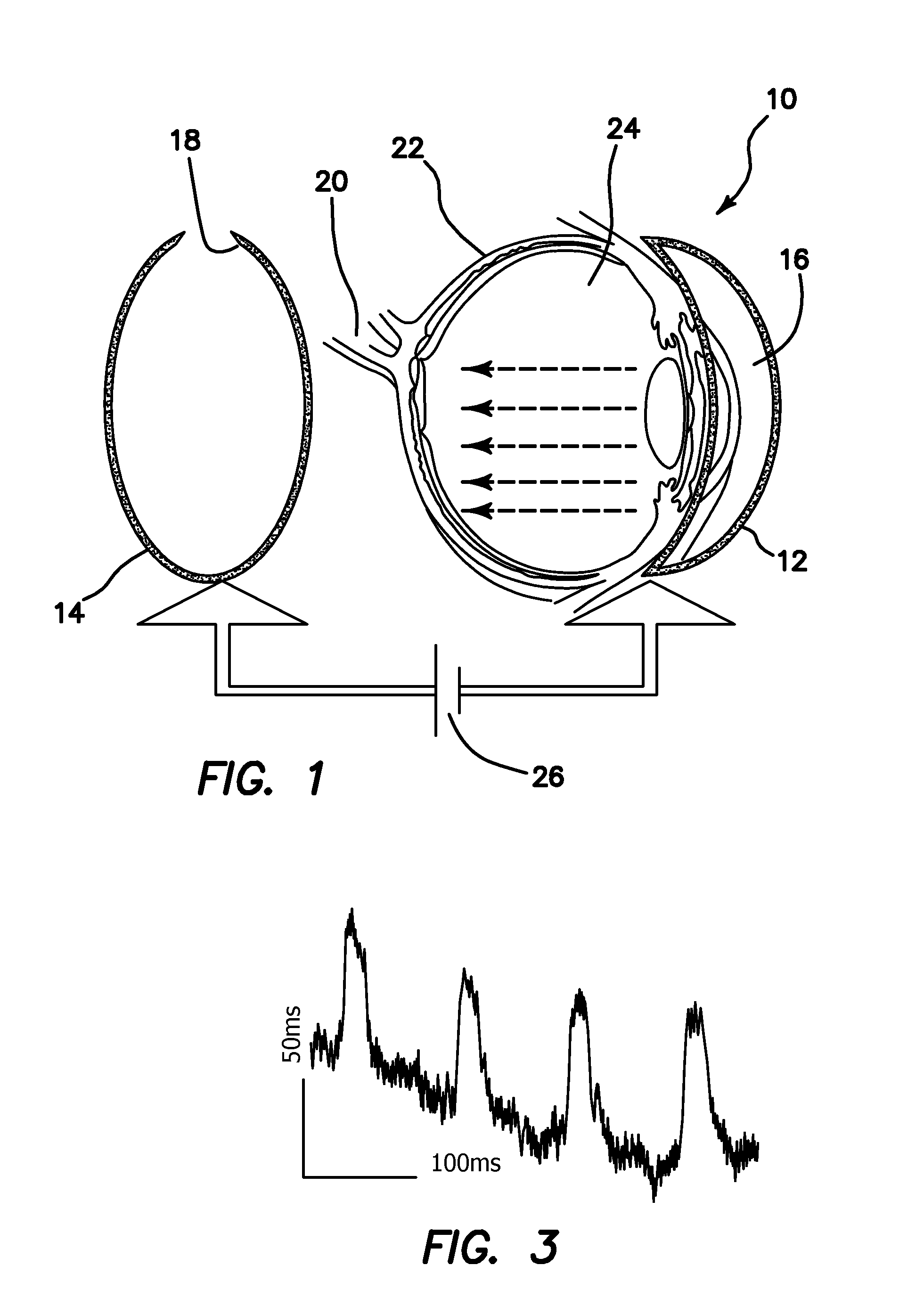 Method and apparatus for optogenetic treatment of blindness including retinitis pigmentosa