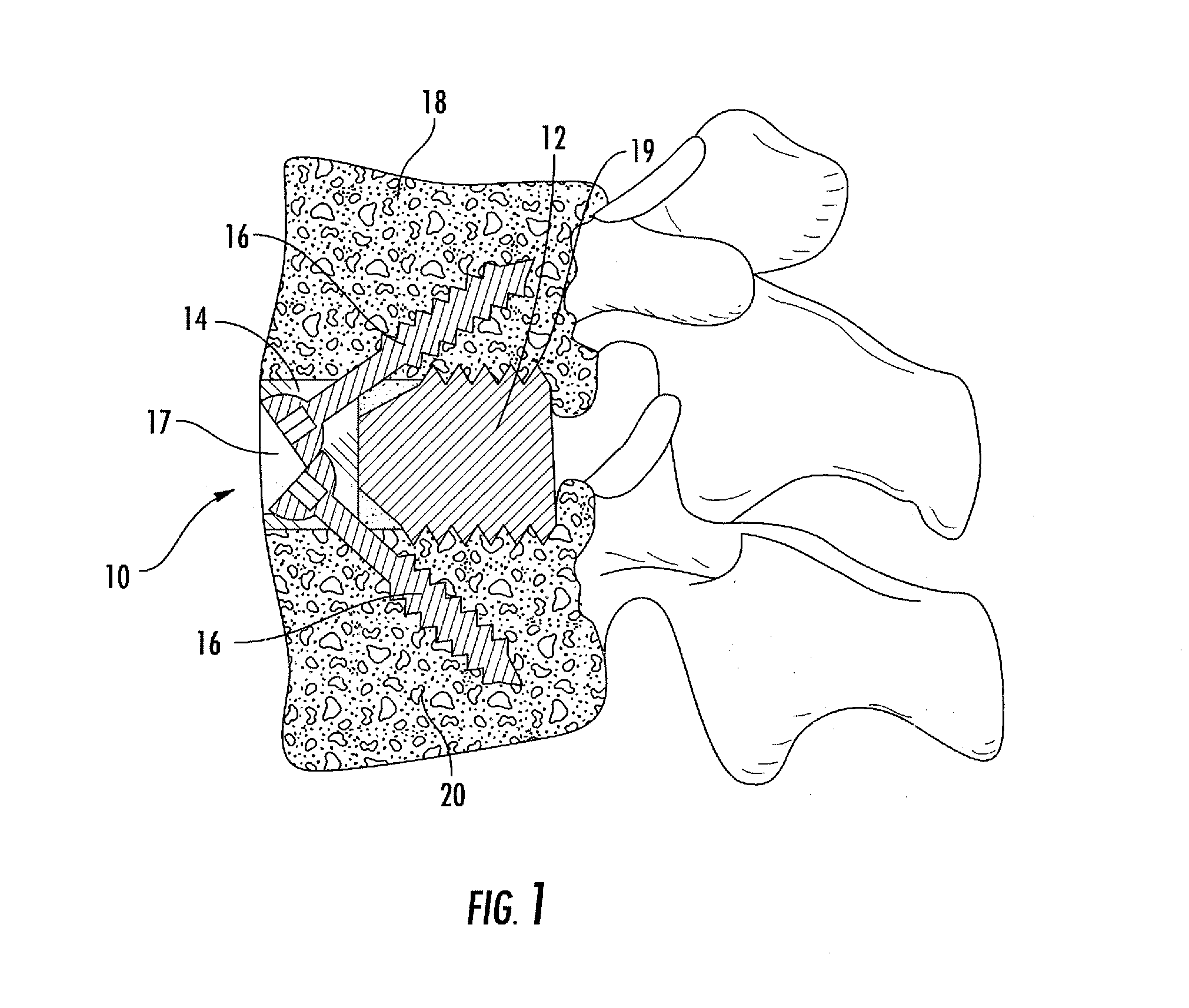 Interbody fusion system with intervertebral implant retention assembly