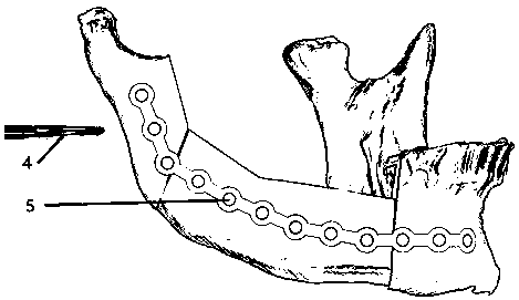 A rapid conversion method of space position between titanium plate and osteotomy guide plate in mandibular surgery