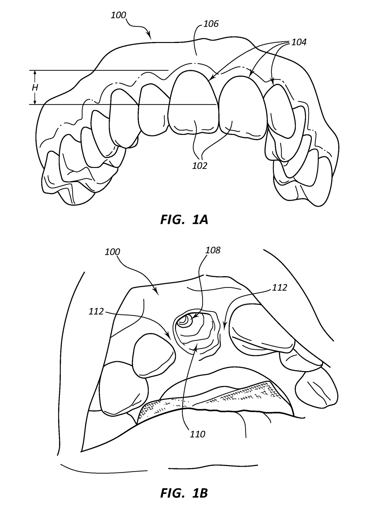 Dental Implants with Markers for Determining Three-Dimensional Positioning