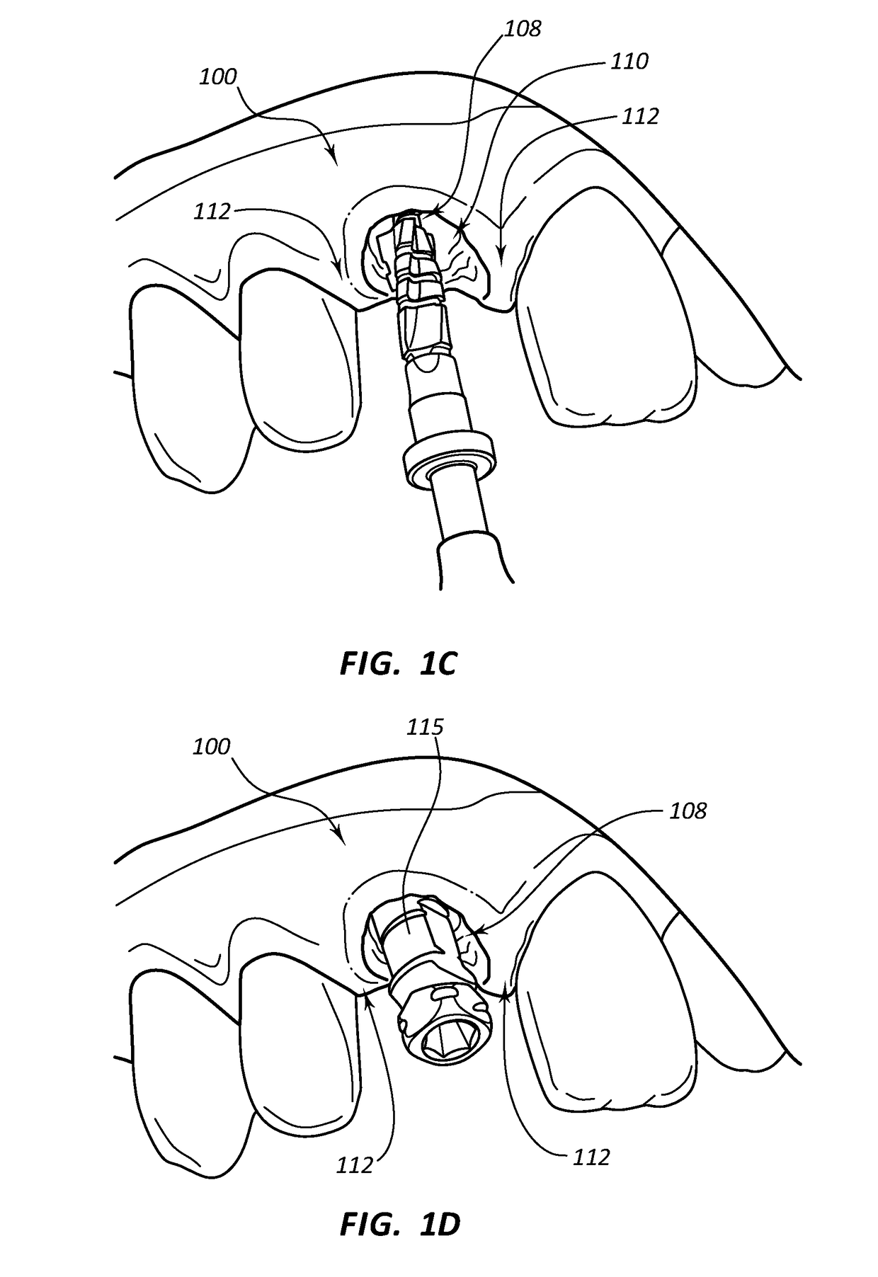 Dental Implants with Markers for Determining Three-Dimensional Positioning