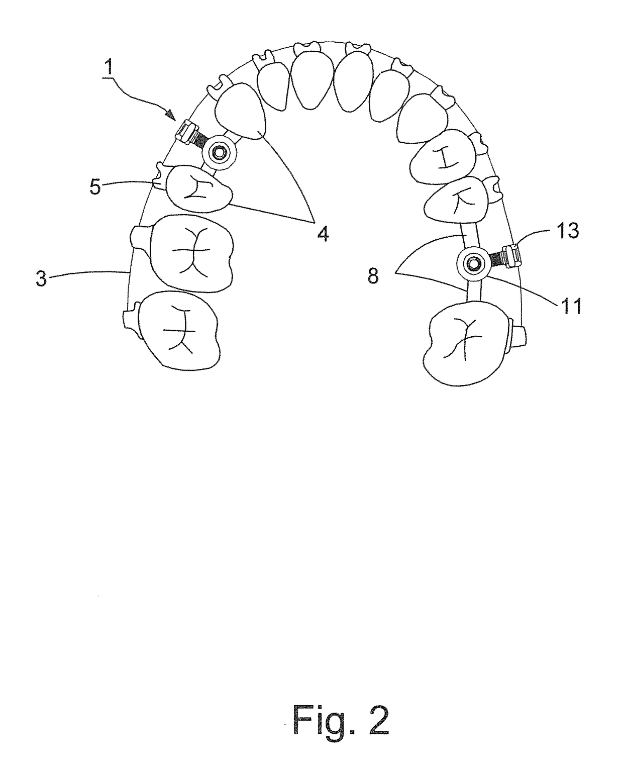 Orthodontic structure capable of implanting implants and straightening teeth