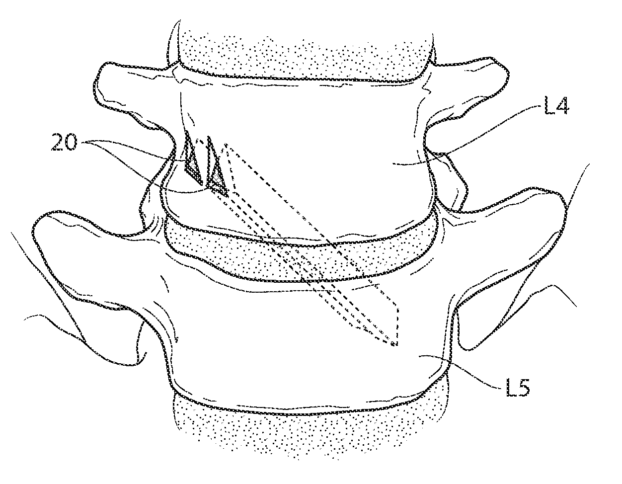 Apparatus, systems, and methods for achieving trans-iliac lumbar fusion