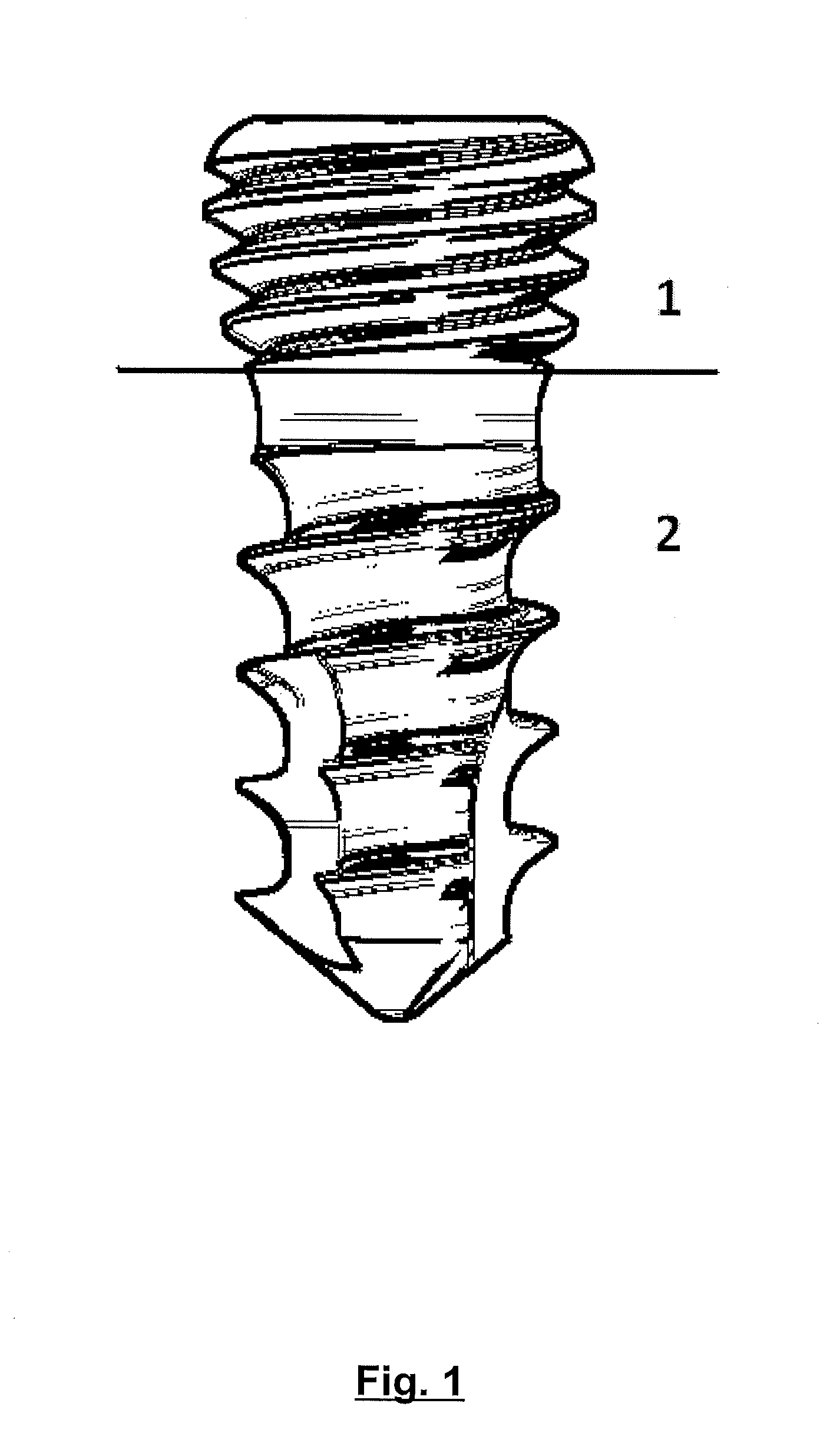 Blocked bone plate and screw provided with a threaded conic or parabolic head and arrangement comprising an implant and respective insertion method of said implant to a bone tissue