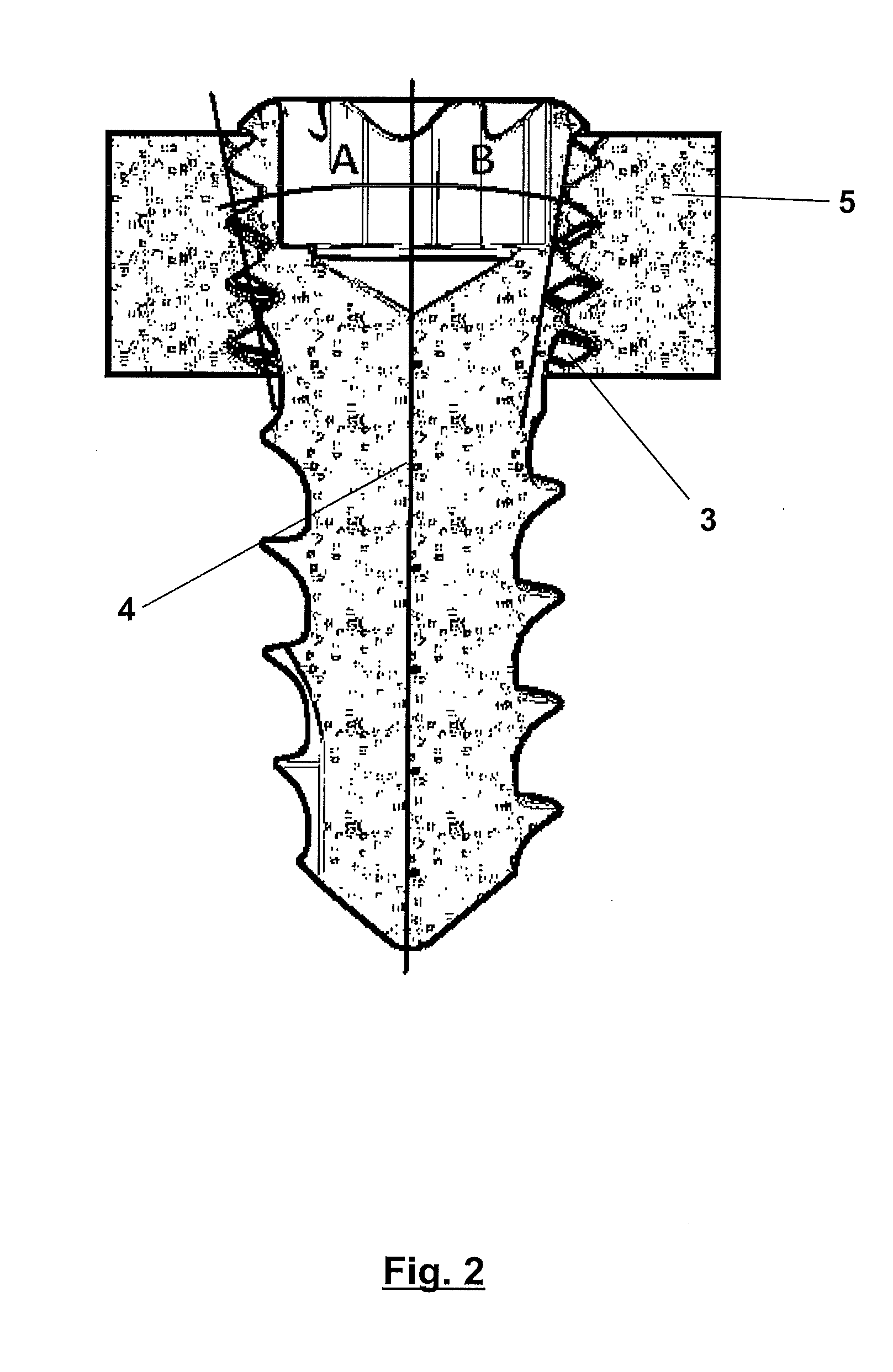 Blocked bone plate and screw provided with a threaded conic or parabolic head and arrangement comprising an implant and respective insertion method of said implant to a bone tissue