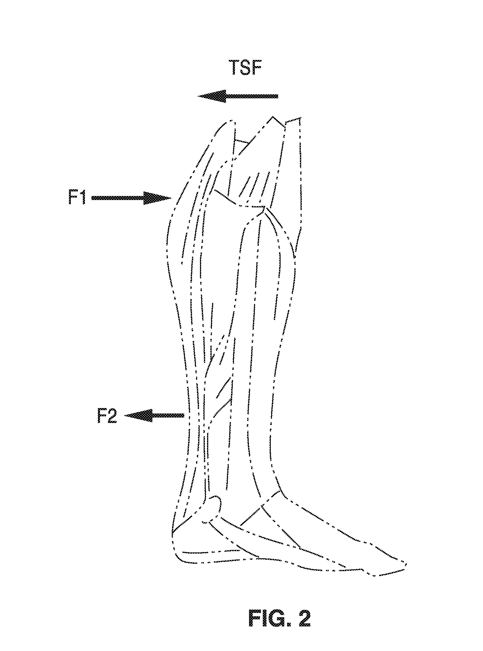 Diagnostic knee arthrometer for detecting acl structural changes