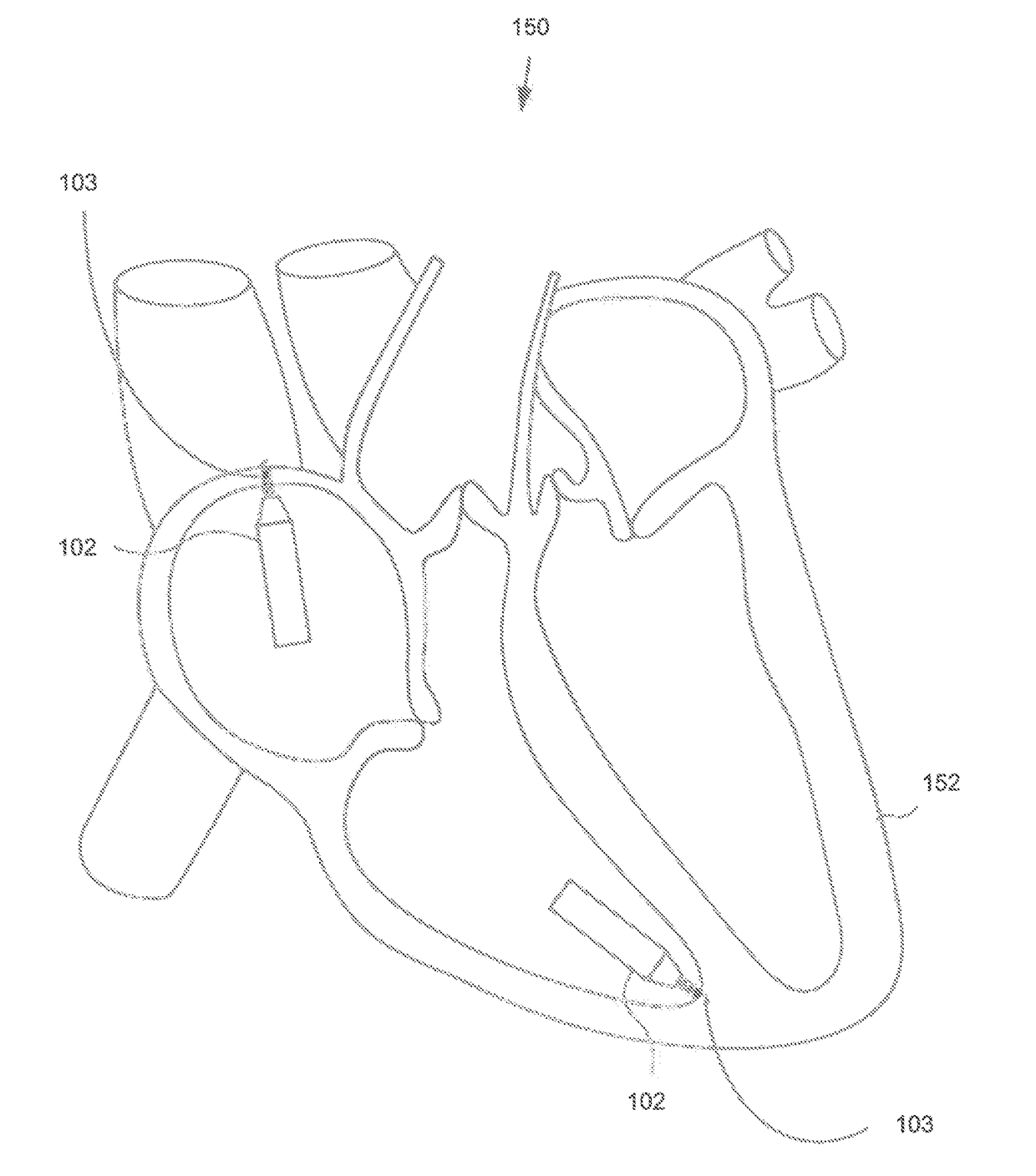 Catheter-based delivery system for delivering a leadless pacemaker and employing a locking hub