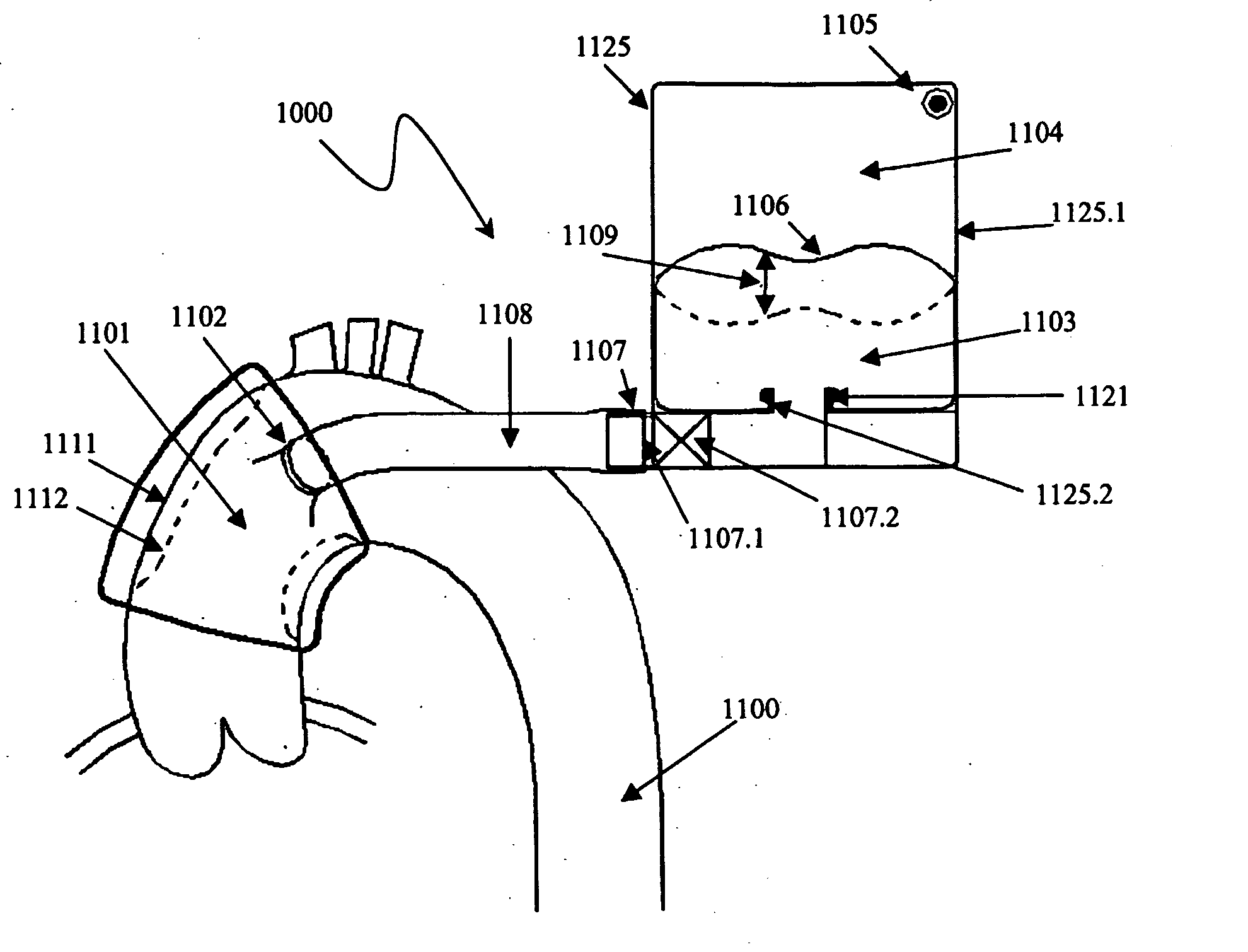 Vessel or Sac Wall Treatment and a Cardiac Assist Device