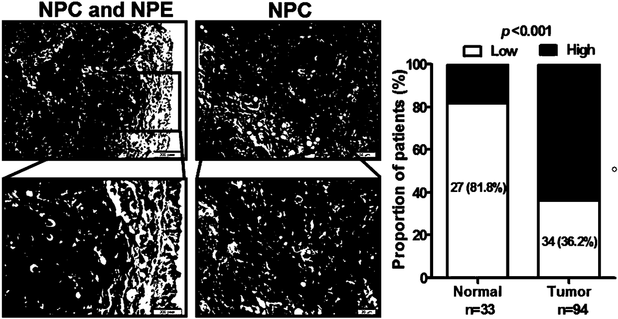 Application of reagent expressed by interference long chain RNA PVT1 in preparing preparation for adjuvant therapy of nasopharyngeal carcinoma