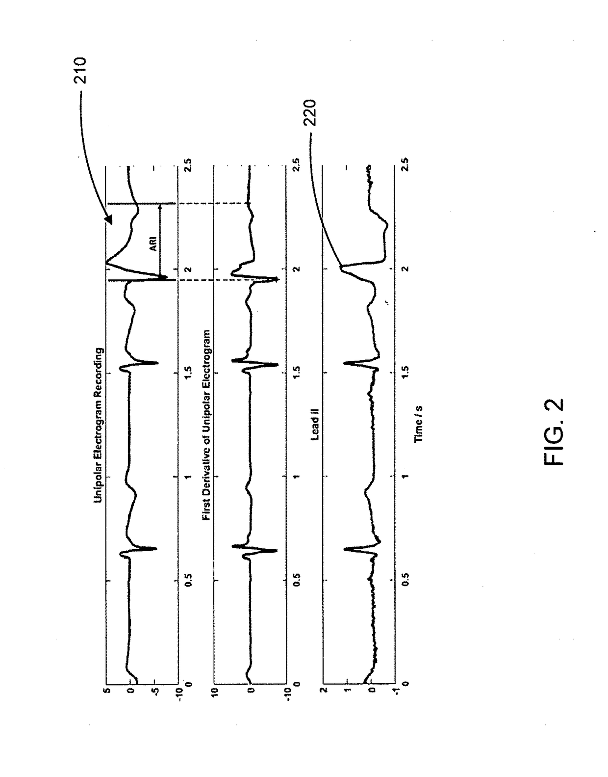 System and method for activation recovery interval imaging of cardiac disorders