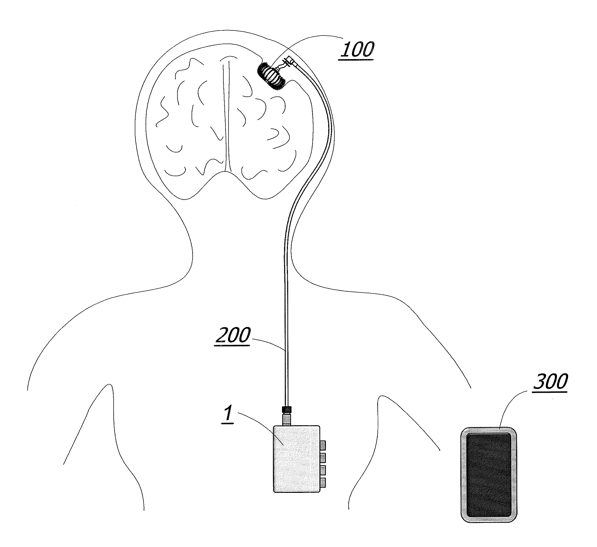 Enhanced method for delivering bevacizumab (avastin) into a brain tumor using an implanted magnetic breather pump