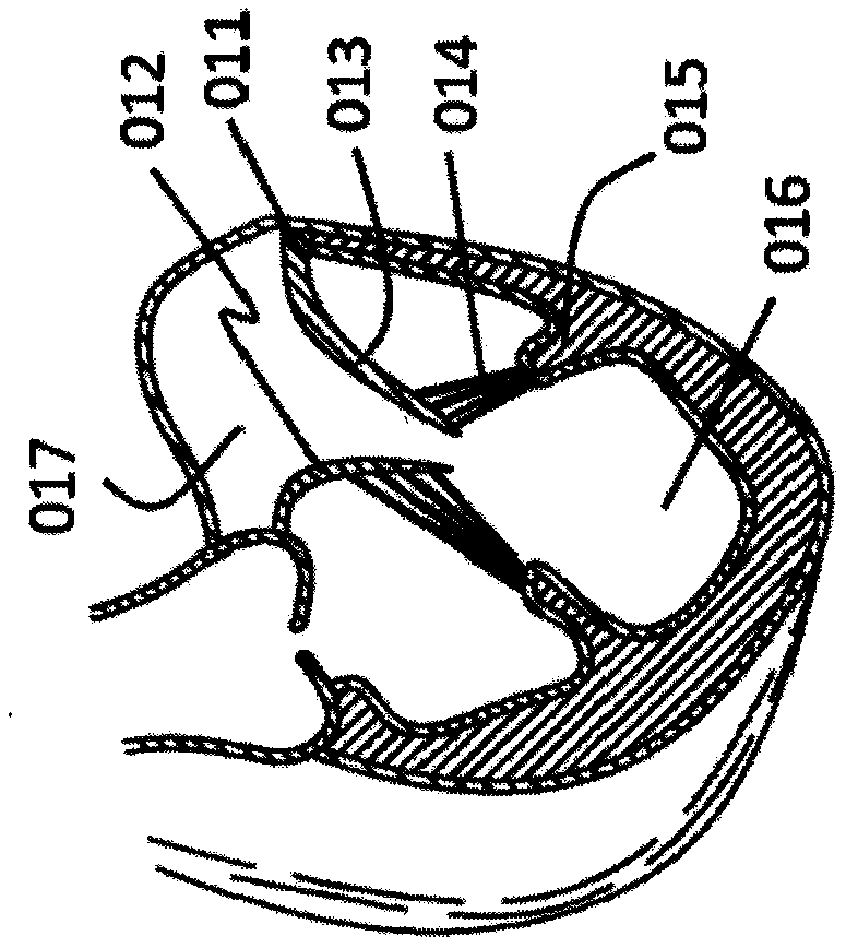 Stent valve prosthesis and conveying system thereof