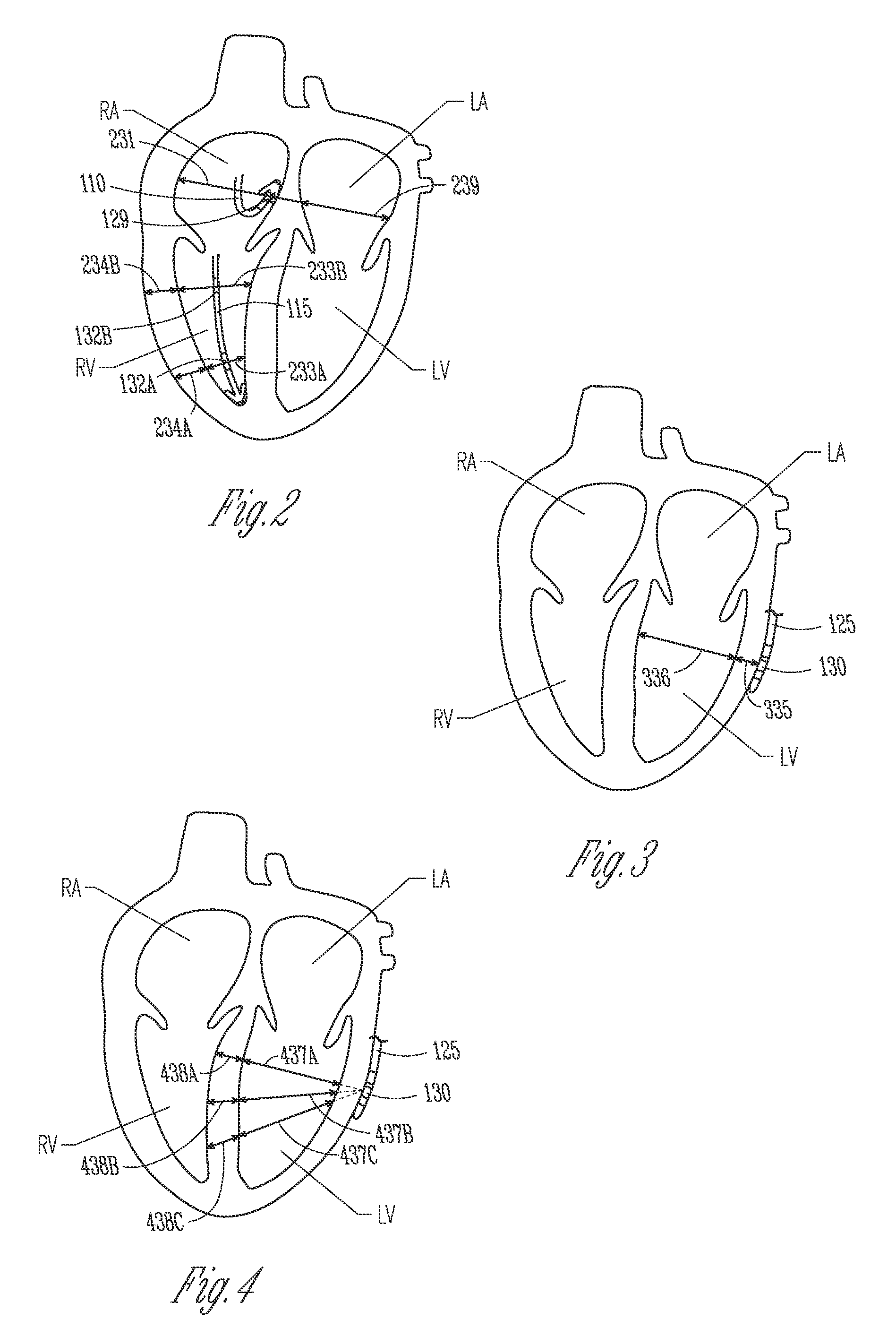 Method and apparatus for controlling cardiac therapy using ultrasound transducer