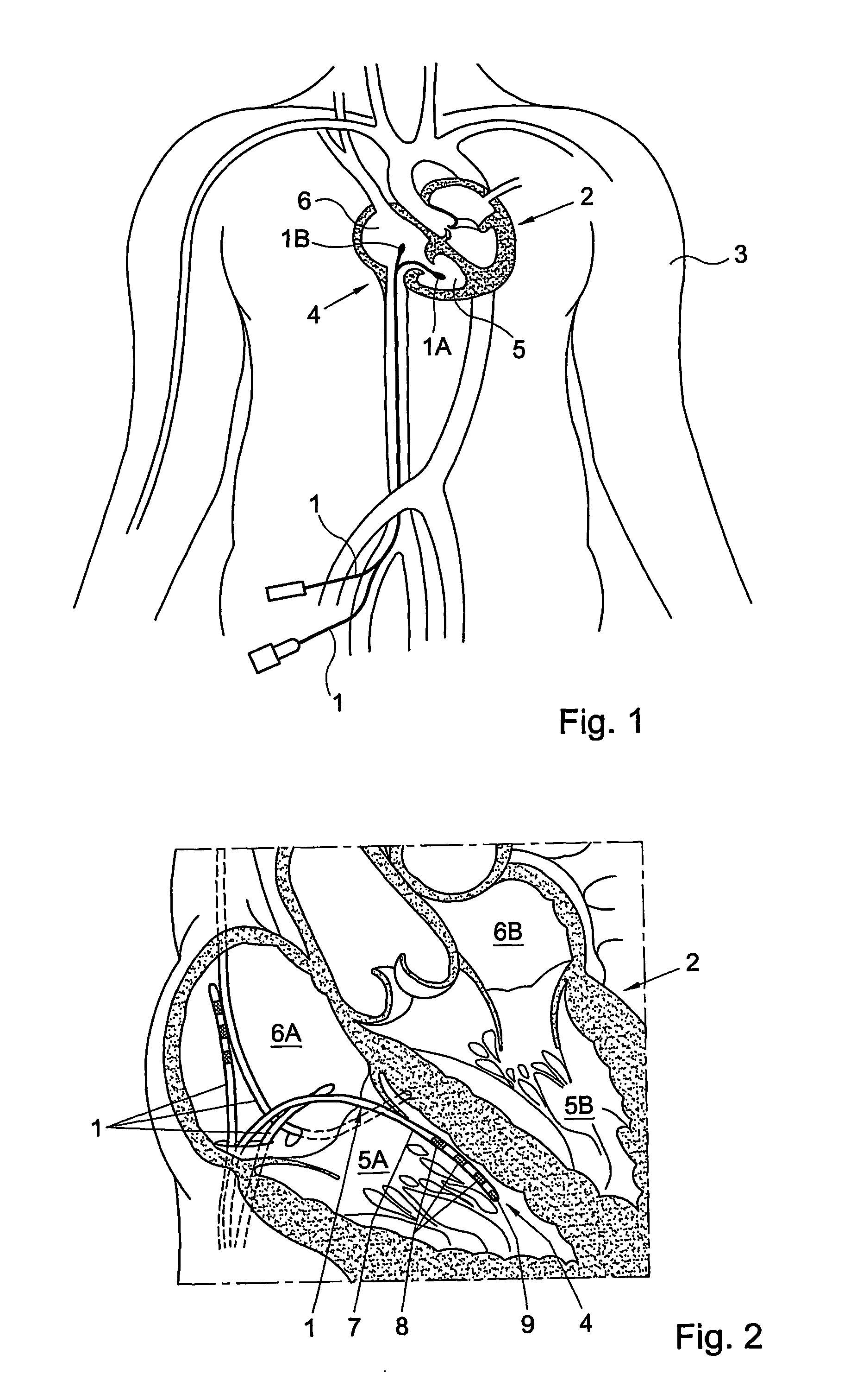 Catheter and method, in particular for ablation and like technique