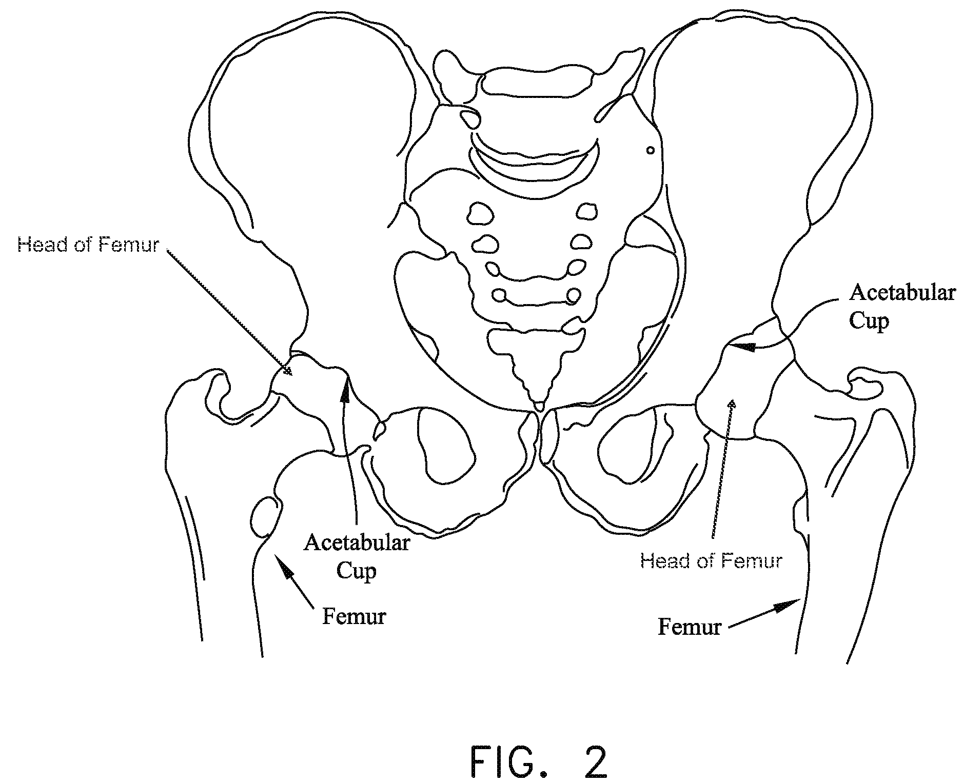 Method and apparatus for distracting a joint, including the provision and use of a novel fluid joint spacer