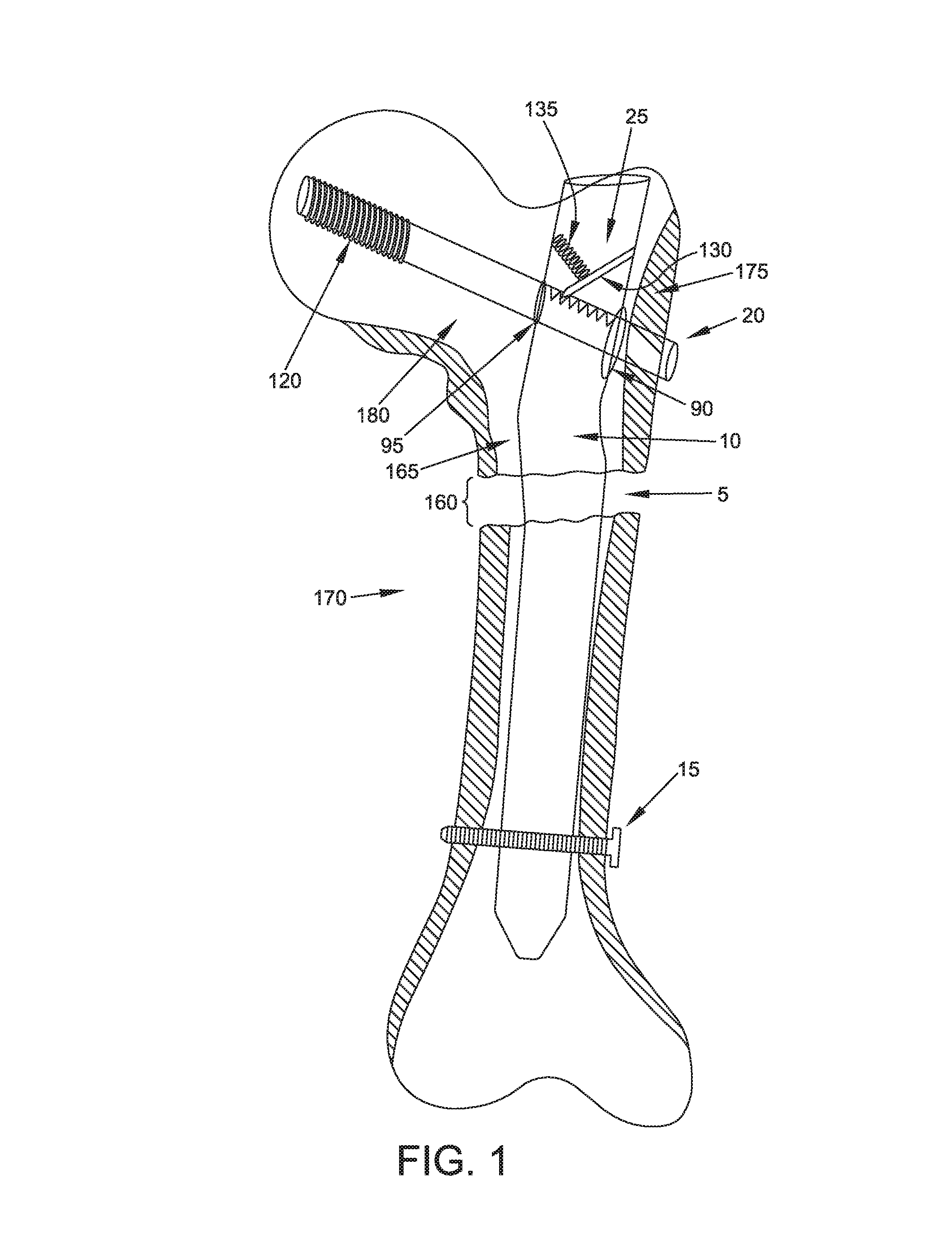 Interlocking intramedullary rod assembly for proximal femoral fractures, including unstable hip fractures