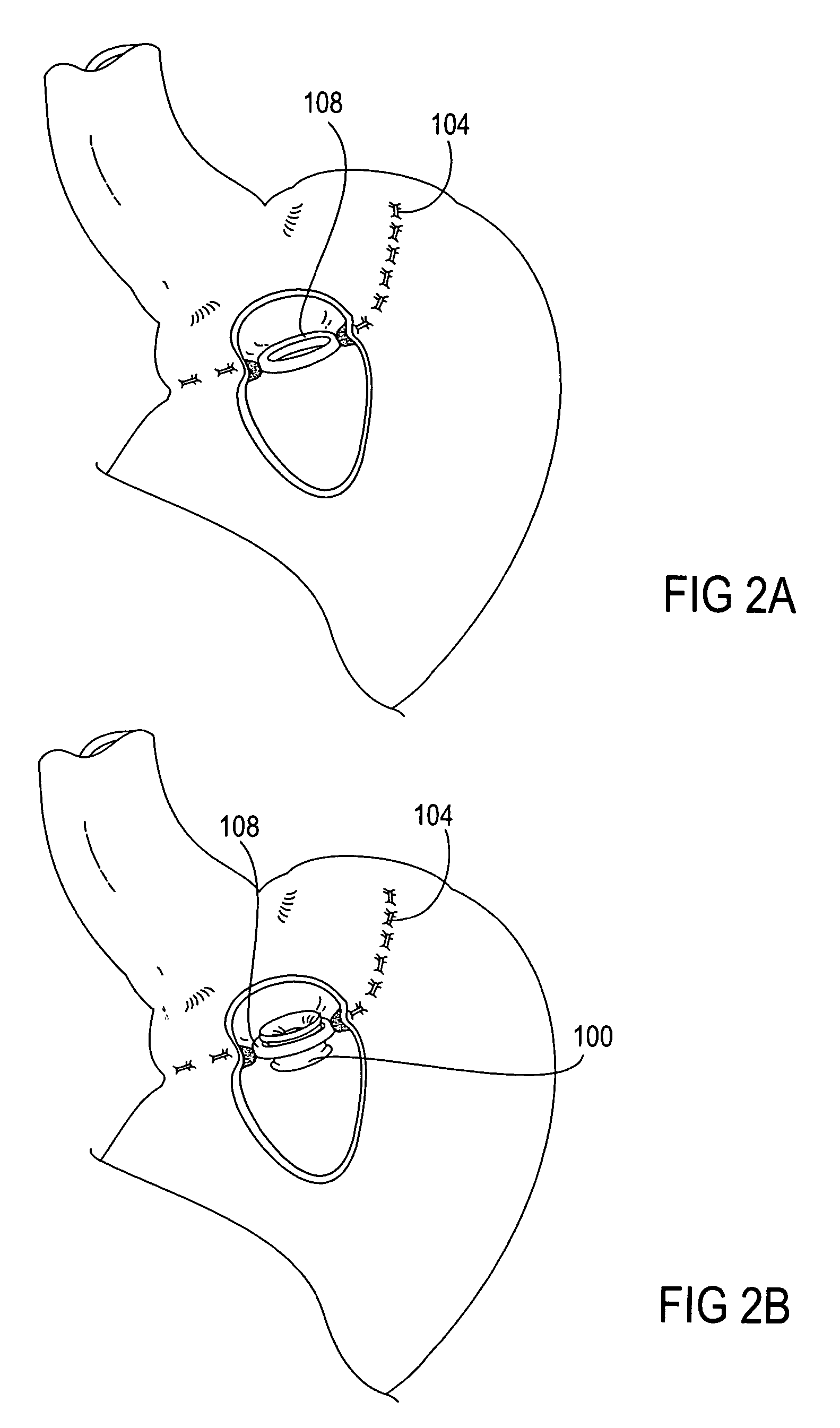 Apparatus and methods for treatment of morbid obesity