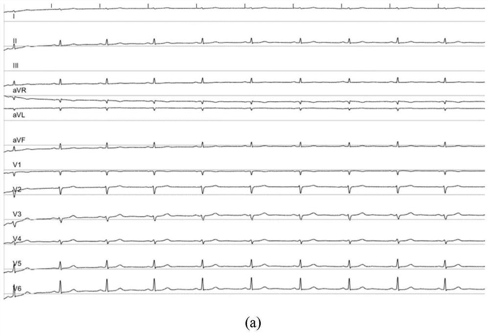 A method for detecting the starting point of qrs complex of multi-lead electrocardiographic signal