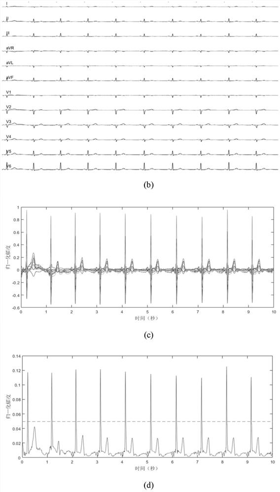 A method for detecting the starting point of qrs complex of multi-lead electrocardiographic signal