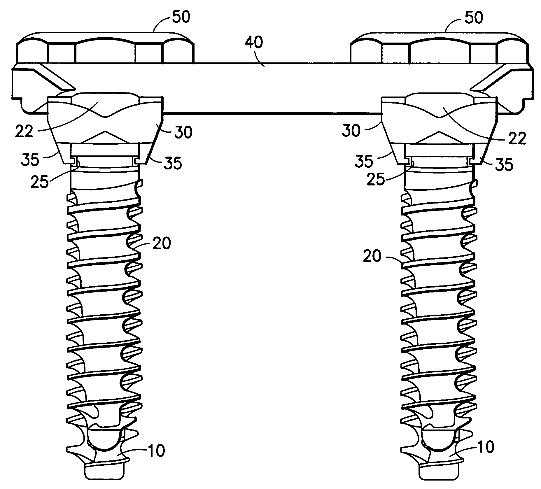 Locking mechanism for a bone screw