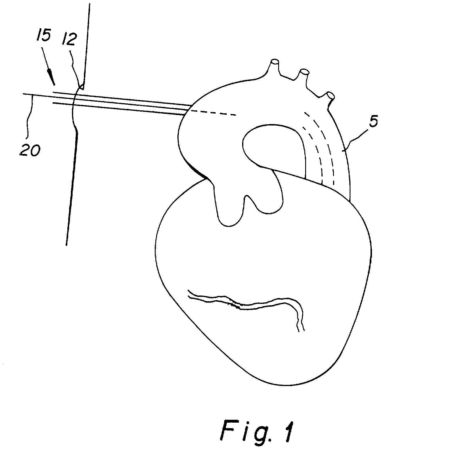 Method and apparatus for performing an anastamosis