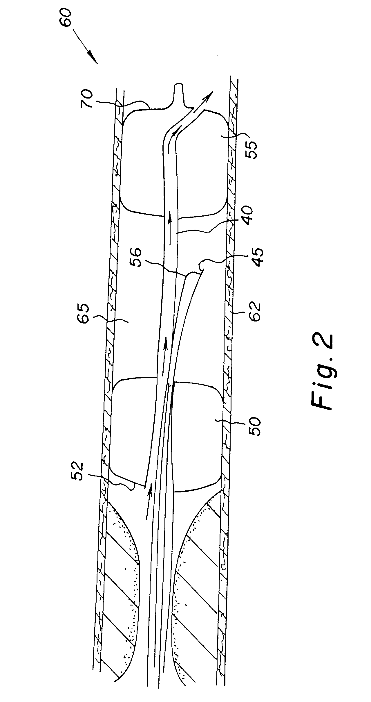 Method and apparatus for performing an anastamosis